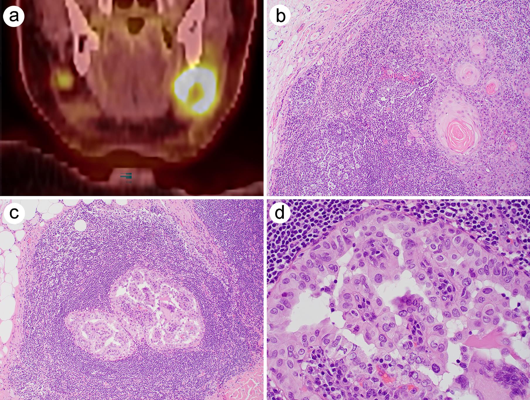 Incidental identified papillary thyroid carcinoma in the neck lymph node dissection of a 73-year-old male with s history of a lower lip squamous cell carcinoma.