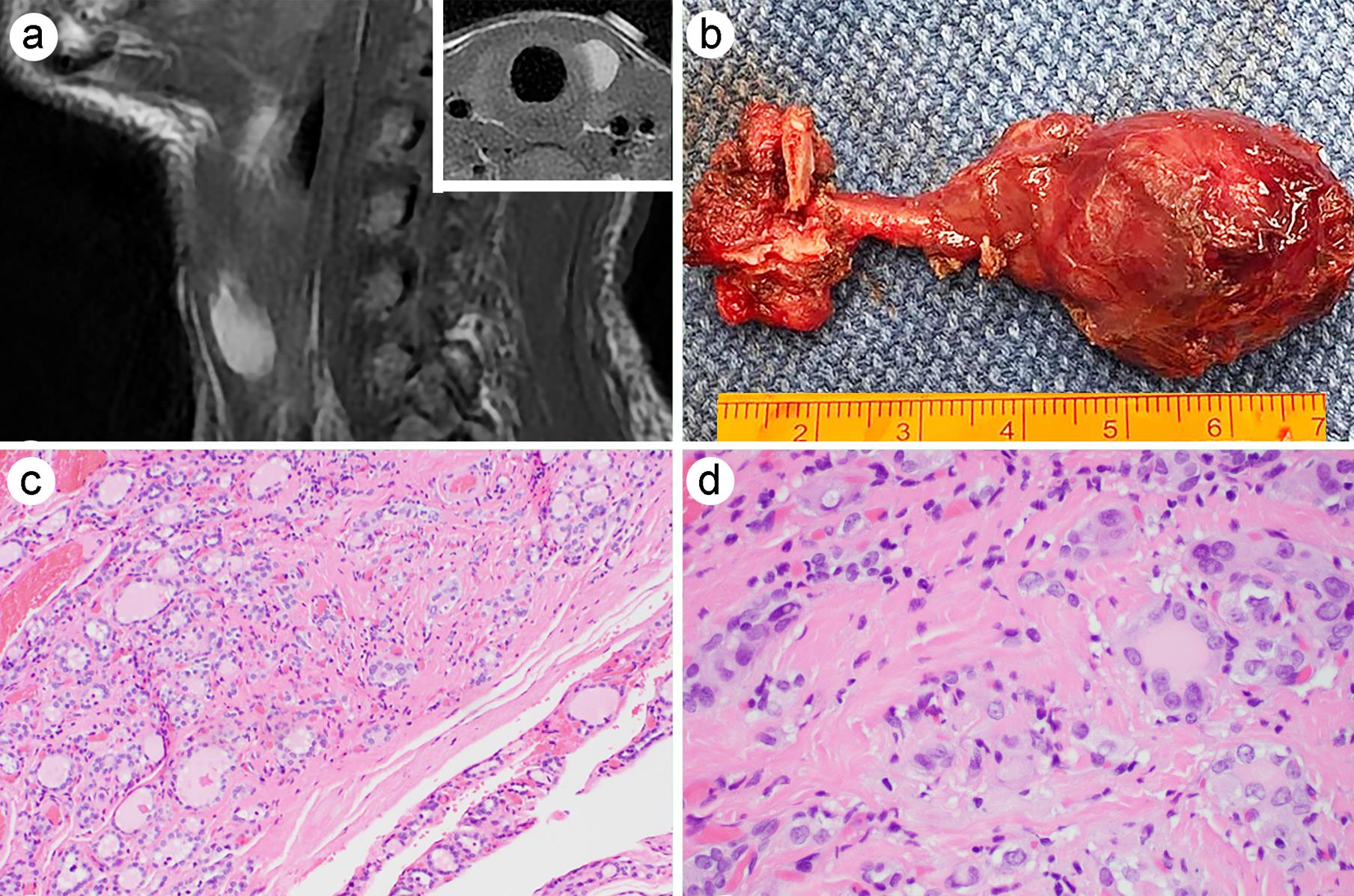 Incidental identification of a papillary thyroid carcinoma (PTC) in a laterally located thyroglossal duct cyst.