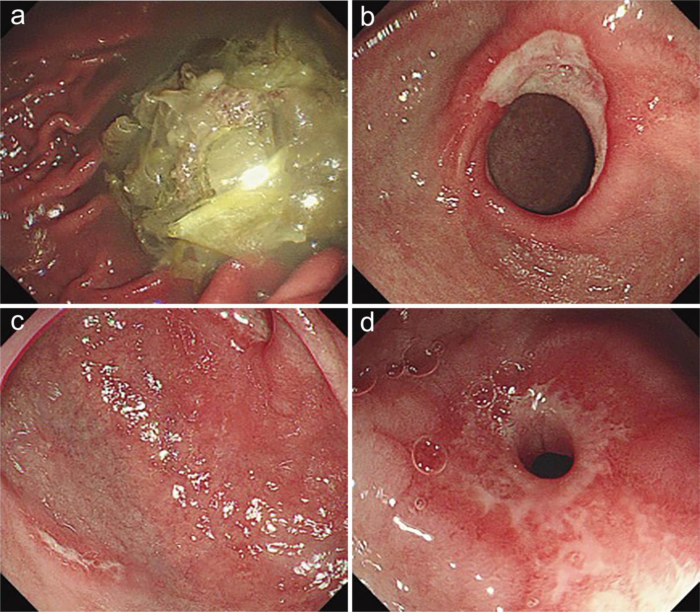 A second esophagogastroduodenoscopy (EGD) in a 70-year-old male with a four-month history of melena.