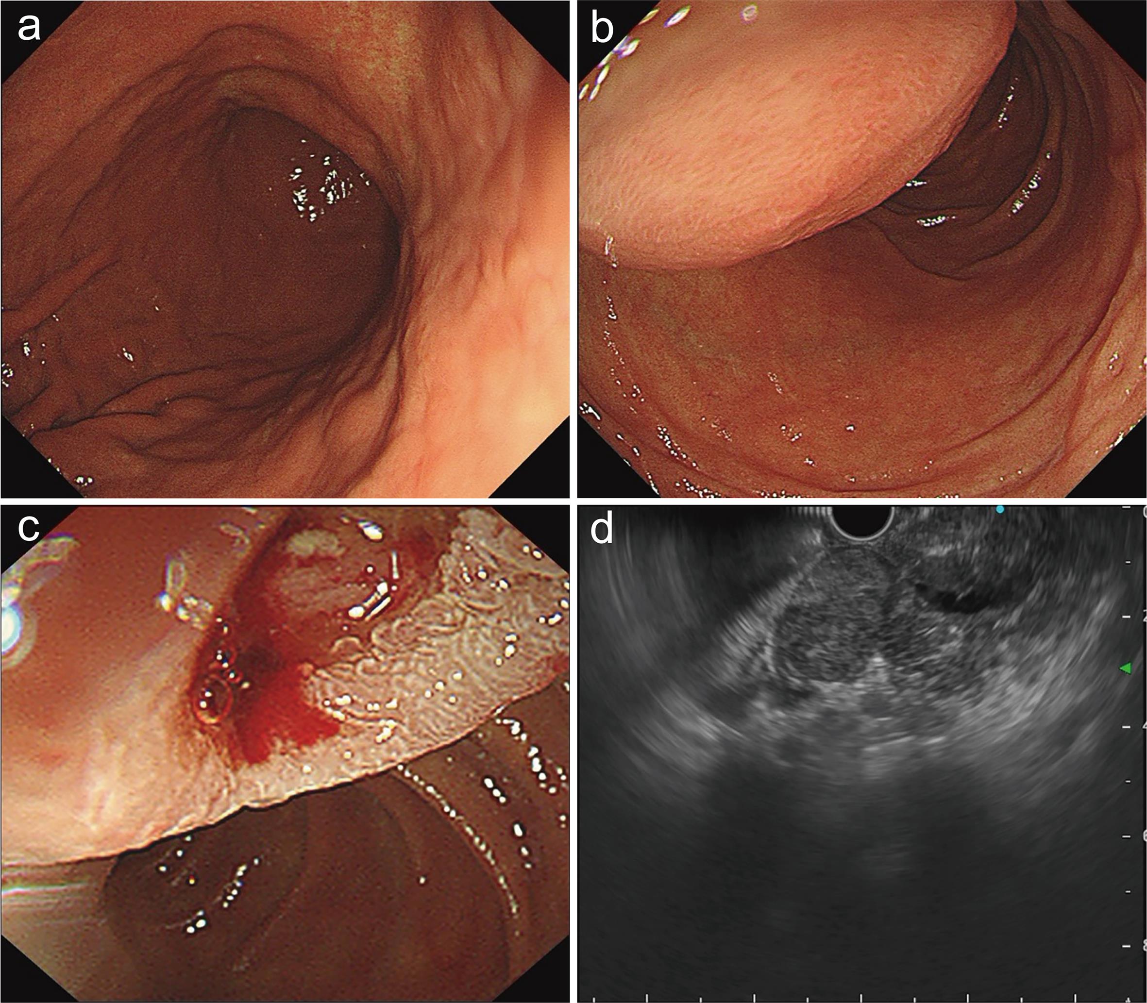 A repeat esophagogastroduodenoscopy (EGD) in a 53-year-old male with a four-month history of intermittent melena.