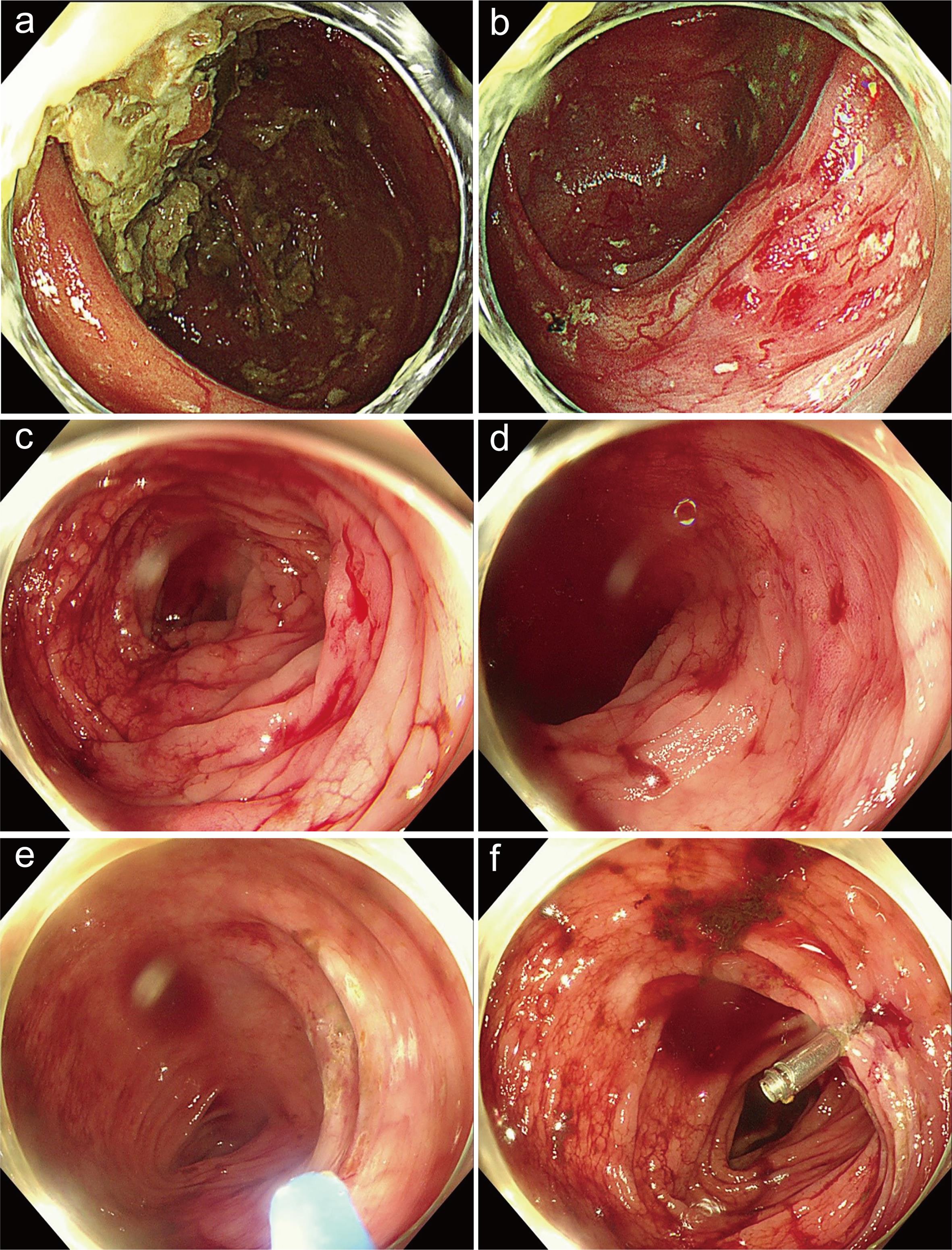 Colonoscopy and repeat colonoscopy for an 80-year-old female with a two-week history of intermittent hematochezia, with no suspicious lesion found on esophagogastroduodenoscopy (EGD).