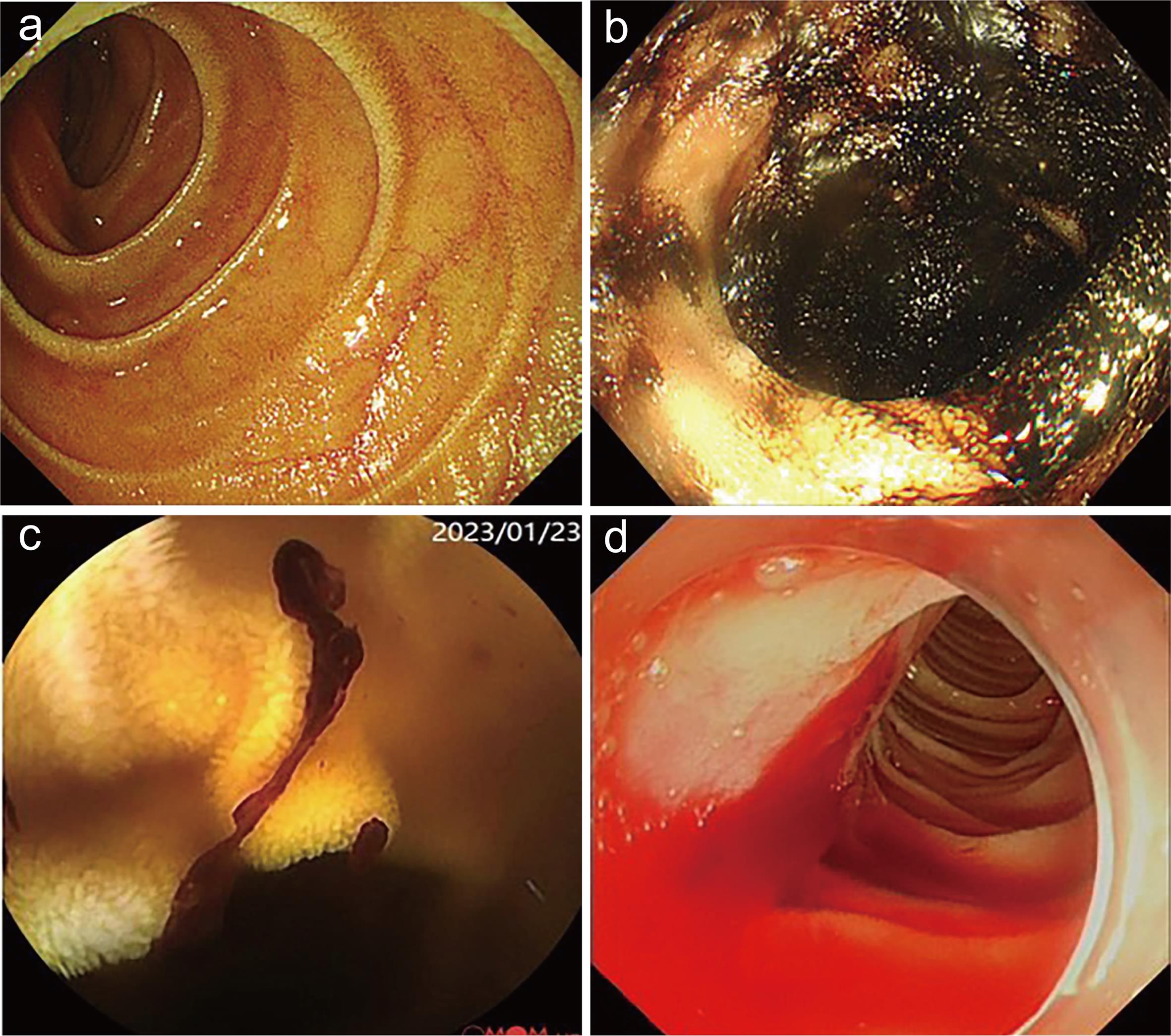 A repeat EGD for an 83-year-old male with a 40-day history of intermittent melena.