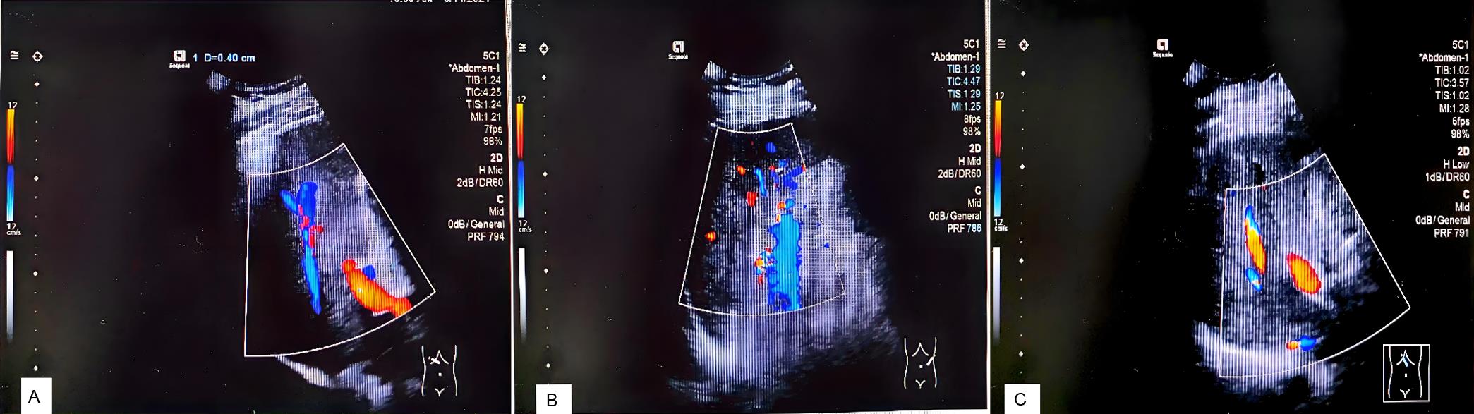 Abdominal ultrasound findings (2024-6-14).