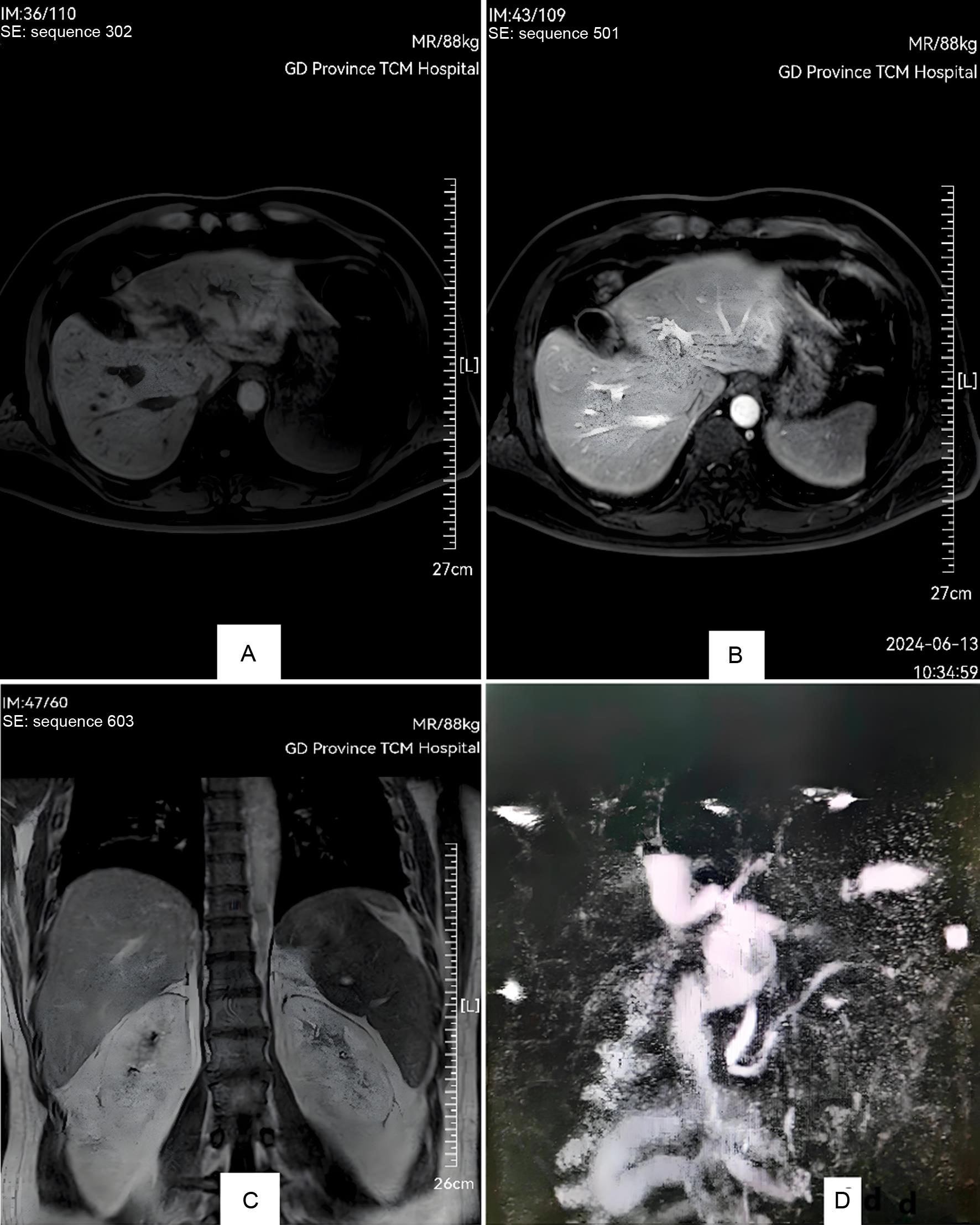 Abdominal MRI + MRCP examination (2024-6-13).