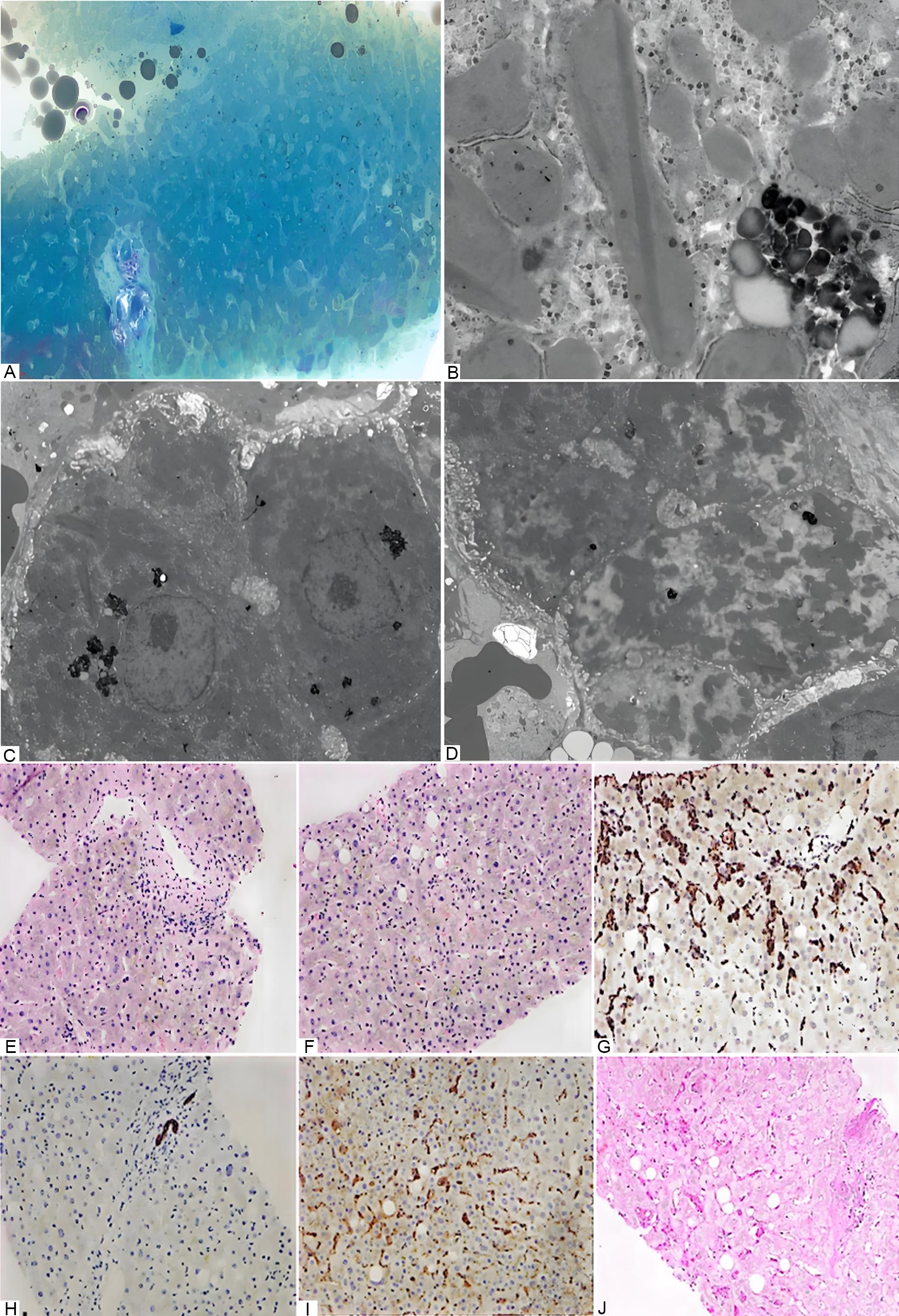 Percutaneous liver biopsy - electron microscopy, immunohistochemistry, and special staining (2024-6-28).