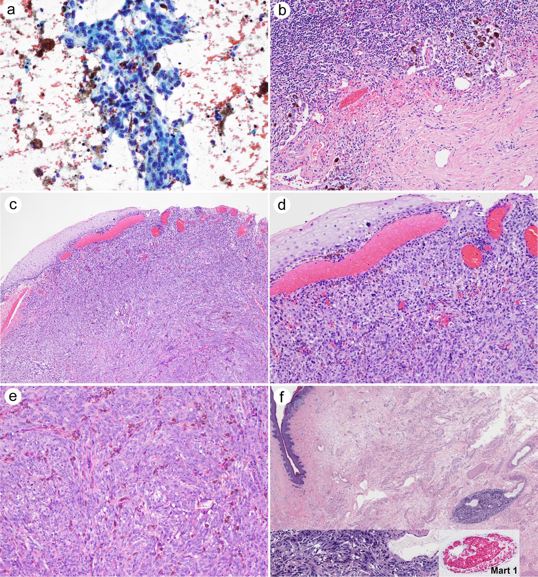 Images of the metastatic lymph node and recurrent melanoma specimen.