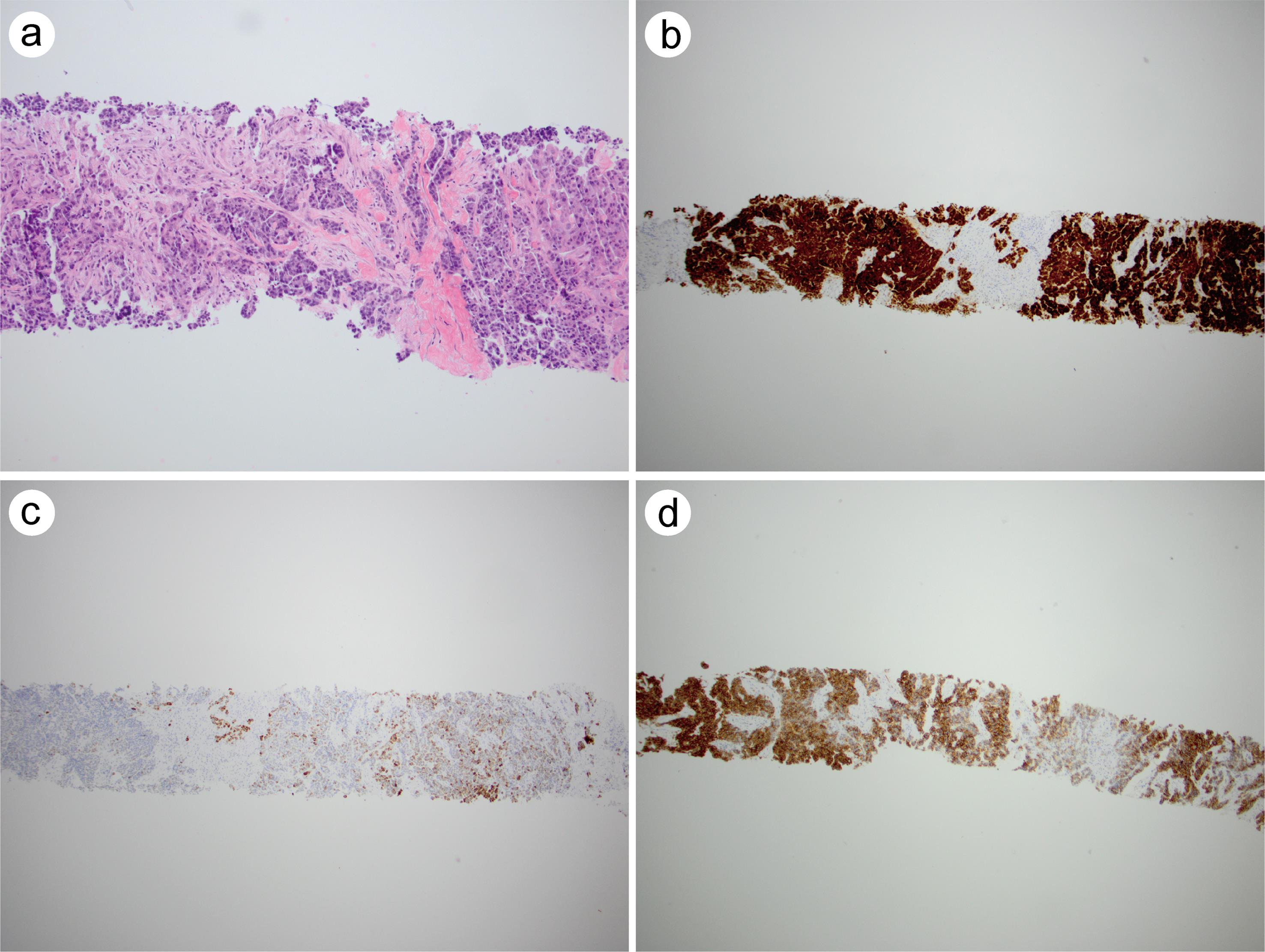 An index case of CAIX expression in epithelioid mesothelioma.