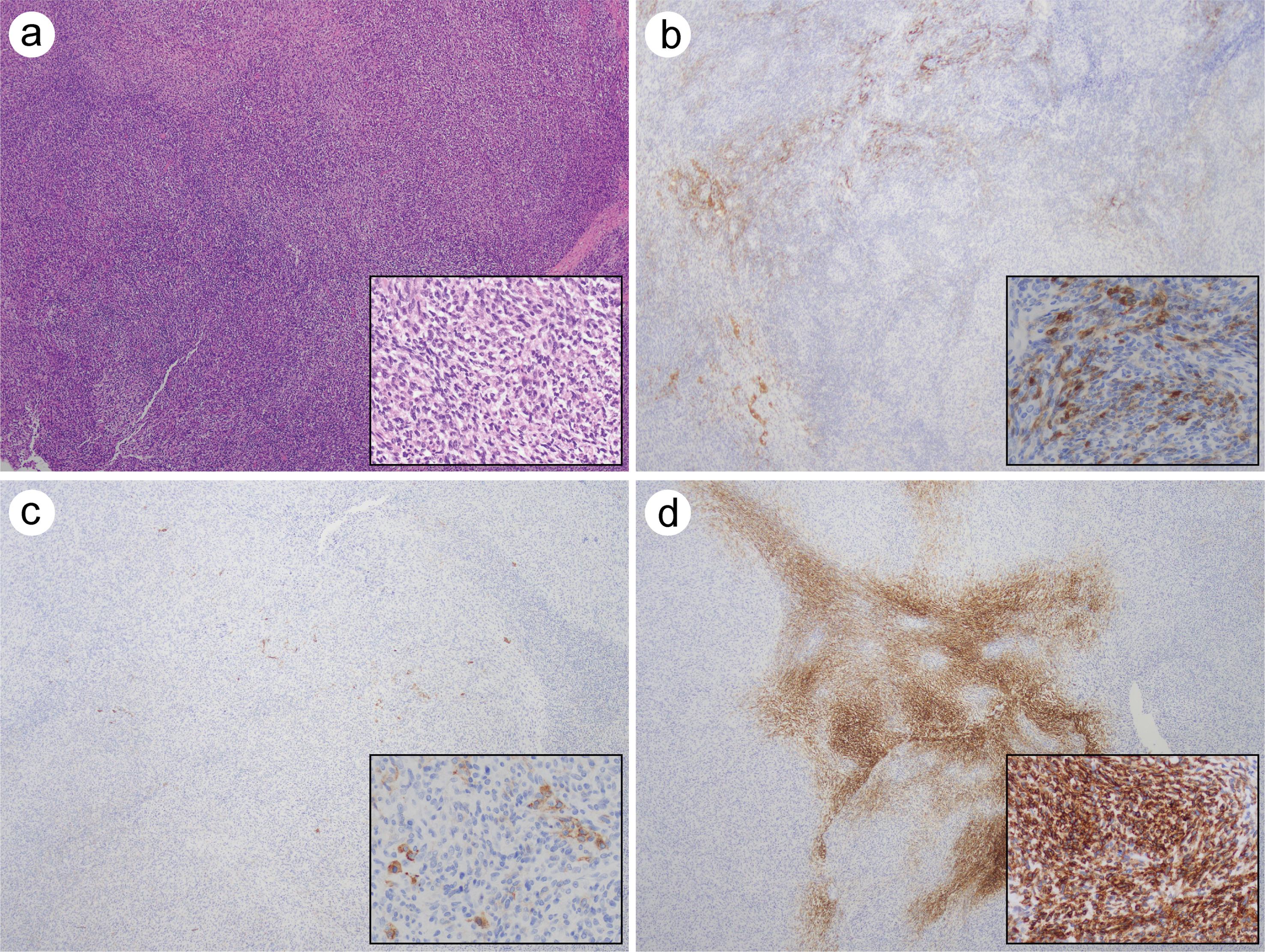 Immunohistochemical studies in a sarcomatoid mesothelioma.