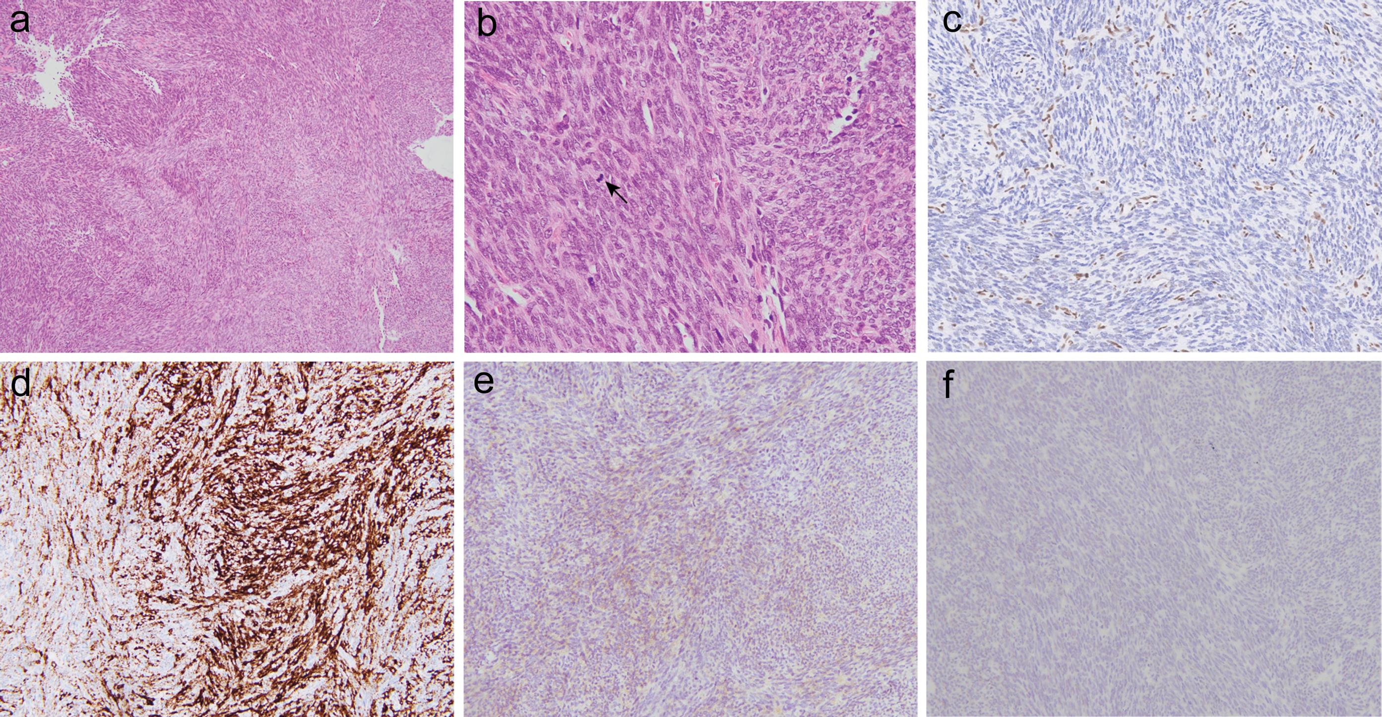 Histopathological and immunohistochemical features of the tumor.