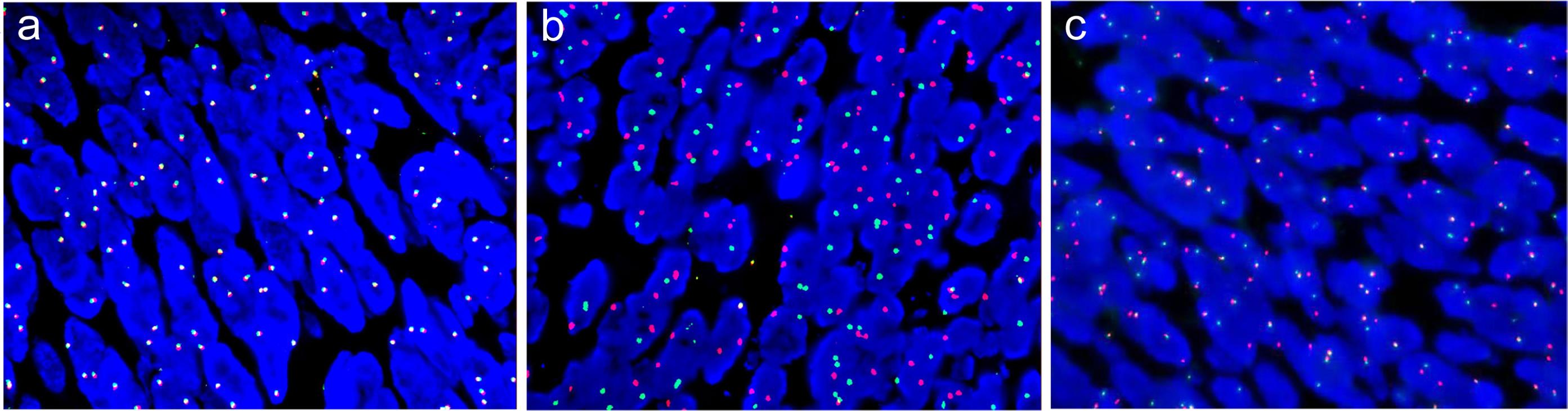 FISH analysis for gene rearrangements.