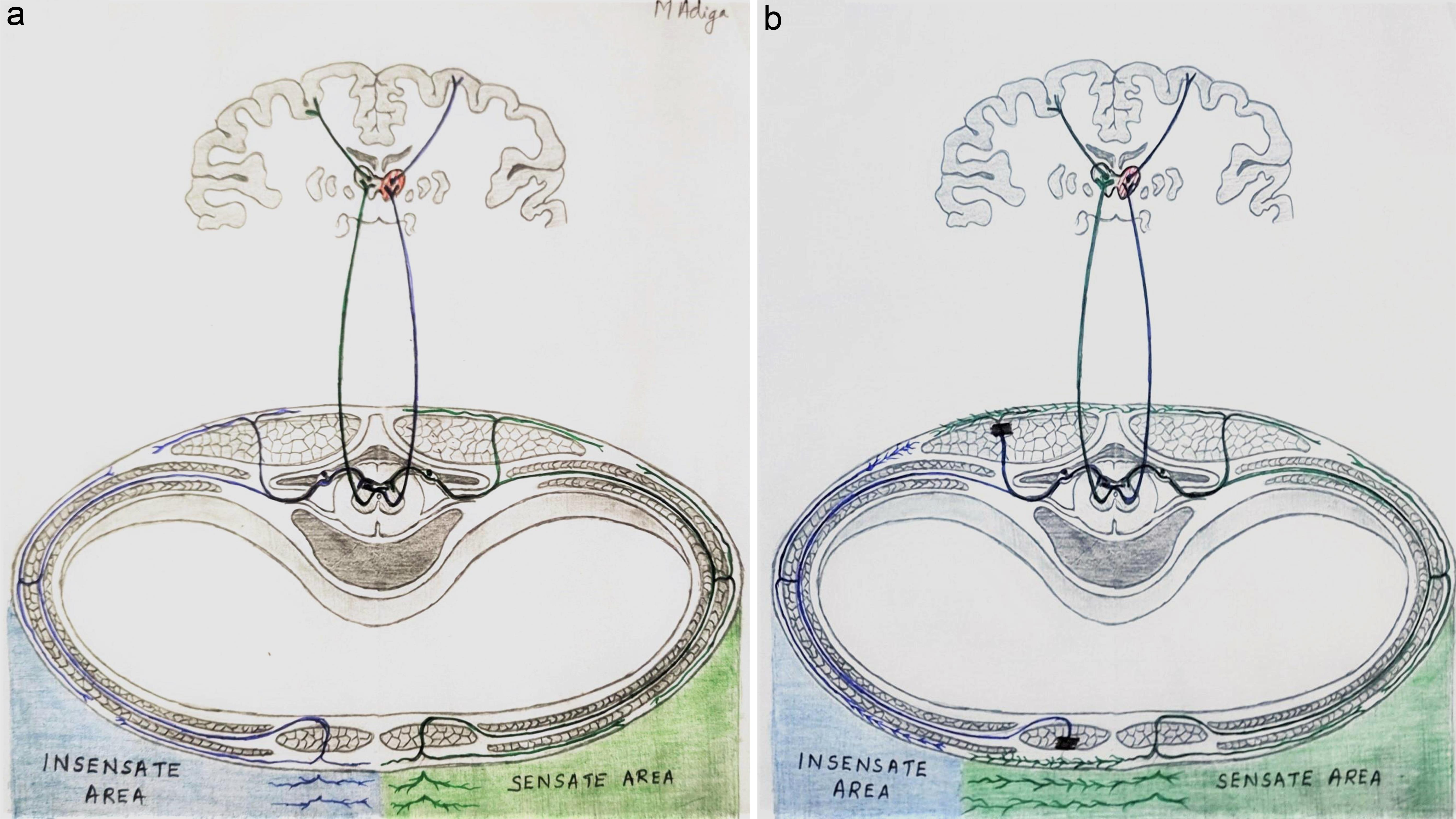 Depiction of rerouting of sensory conduction to the brain in a complete right hemi-anaesthetic stroke (left thalamic infarction) case.