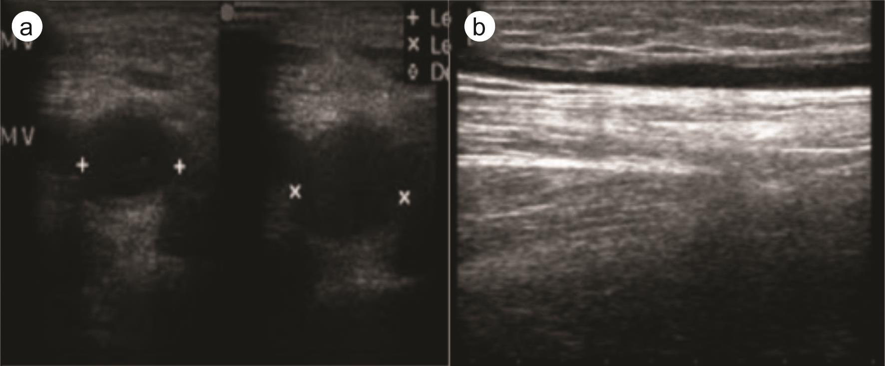 Doppler left lower limb ultrasound.