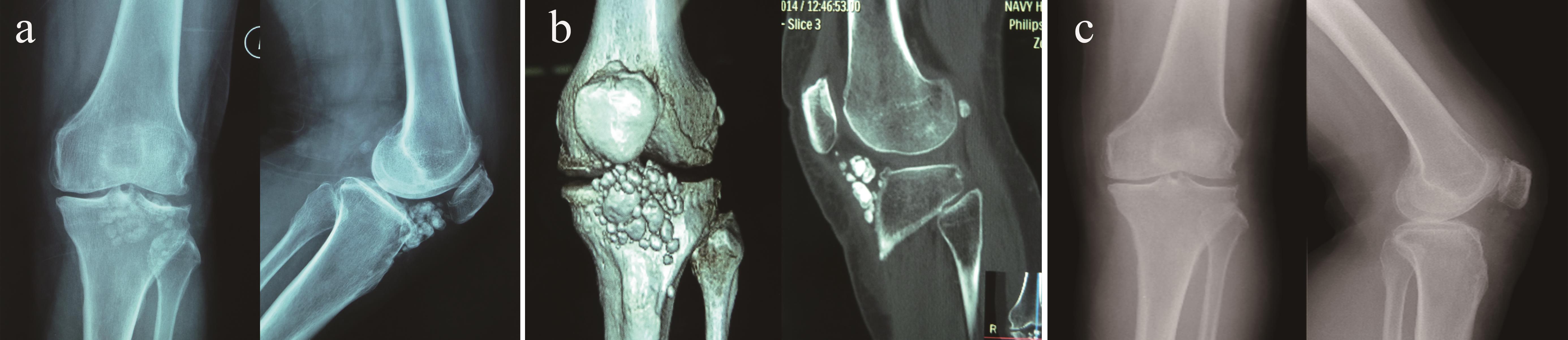 Arthroscopic Treatment of Atypical Synovial Osteochondromatosis of