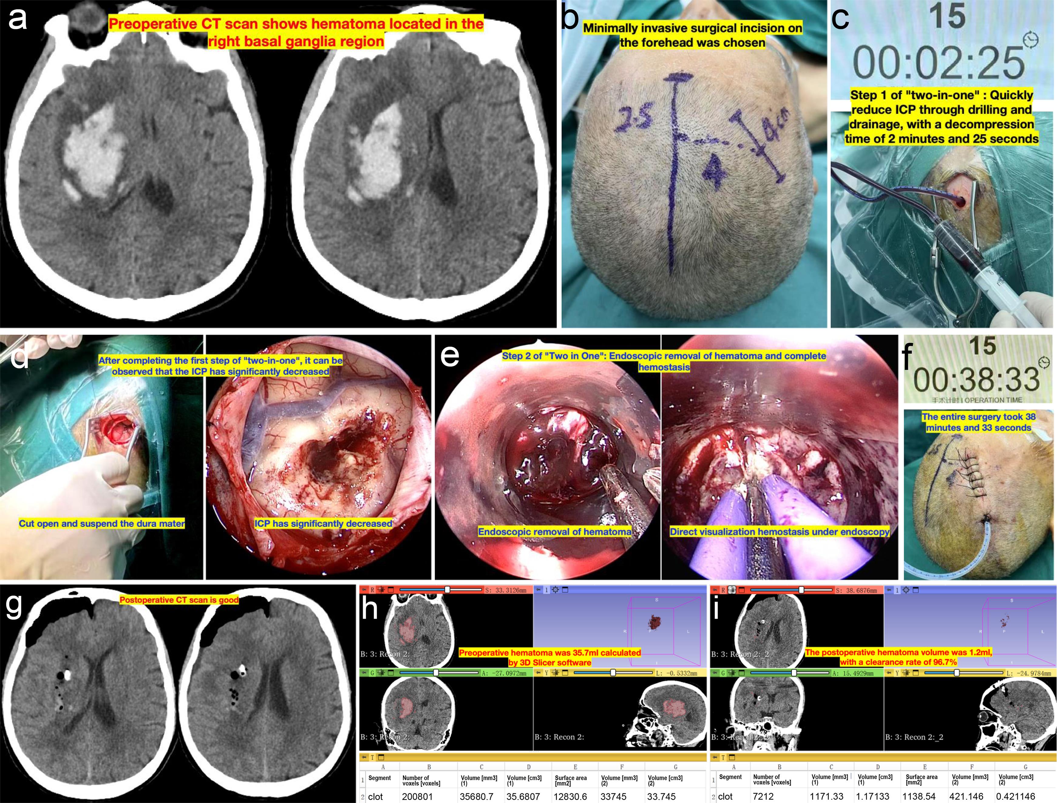 The two-in-one surgical strategy for basal ganglia hemorrhage.
