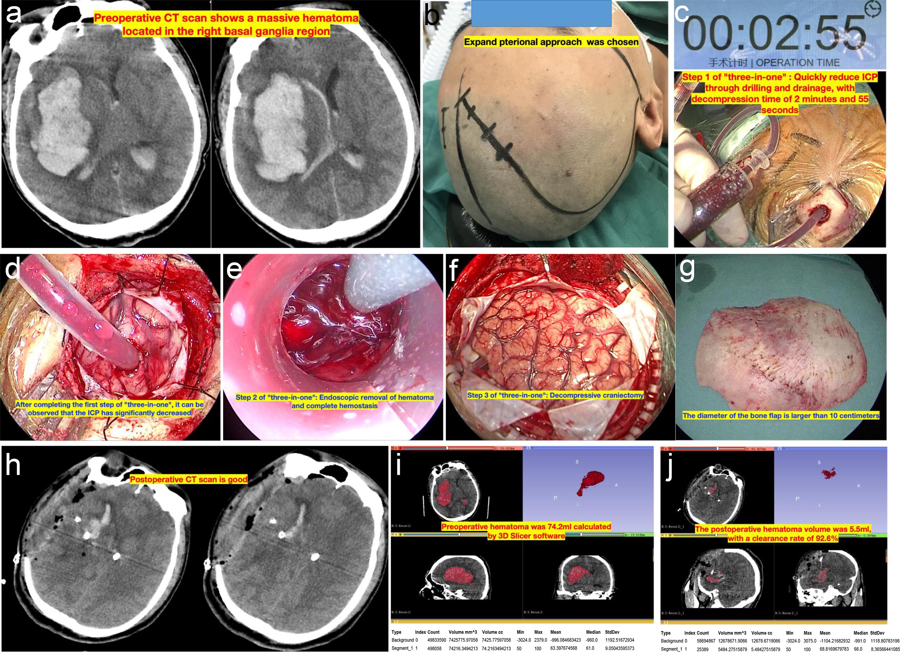 The three-in-one surgical strategy for large hematoma volume.