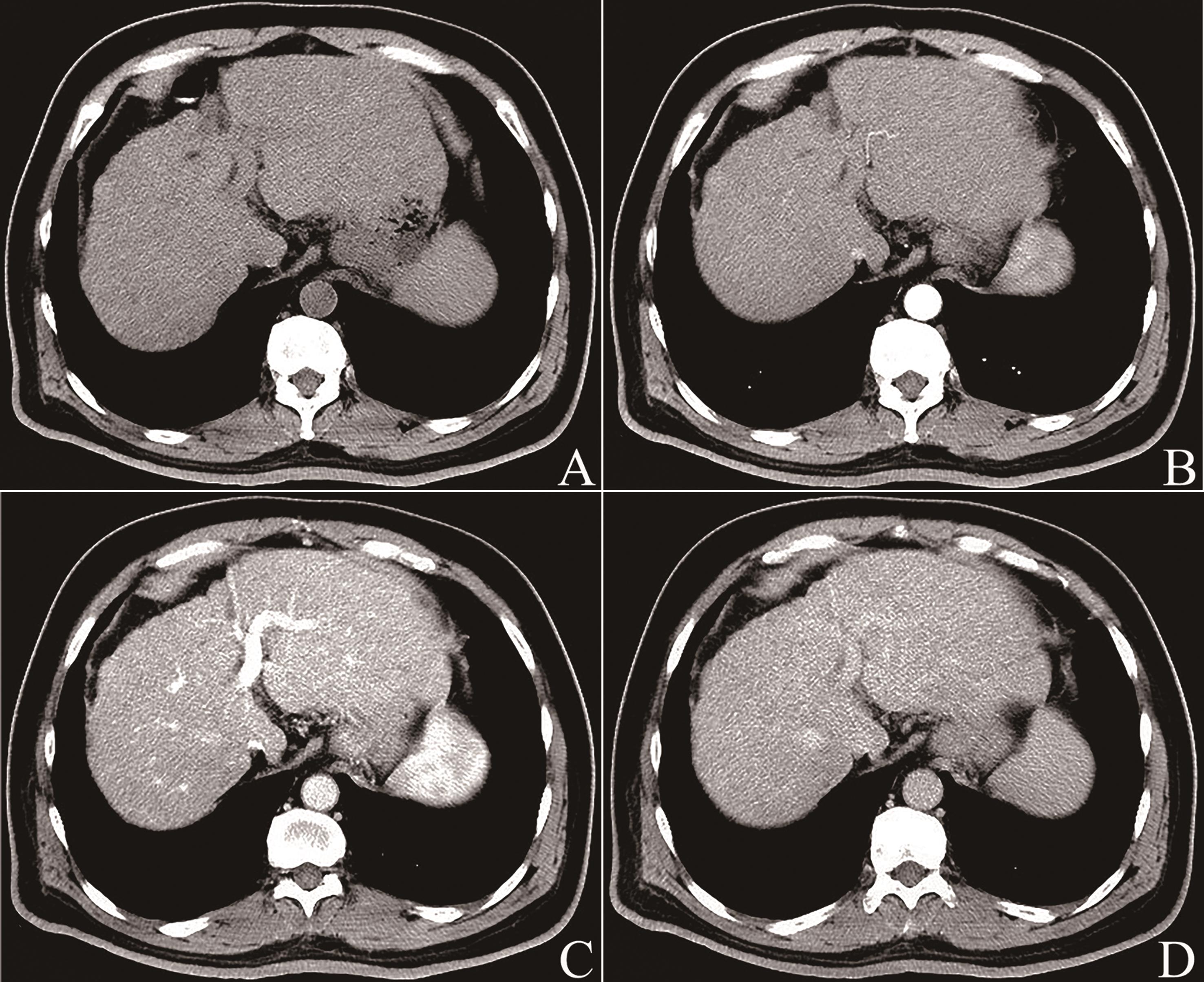 CT images of liver cirrhosis.
