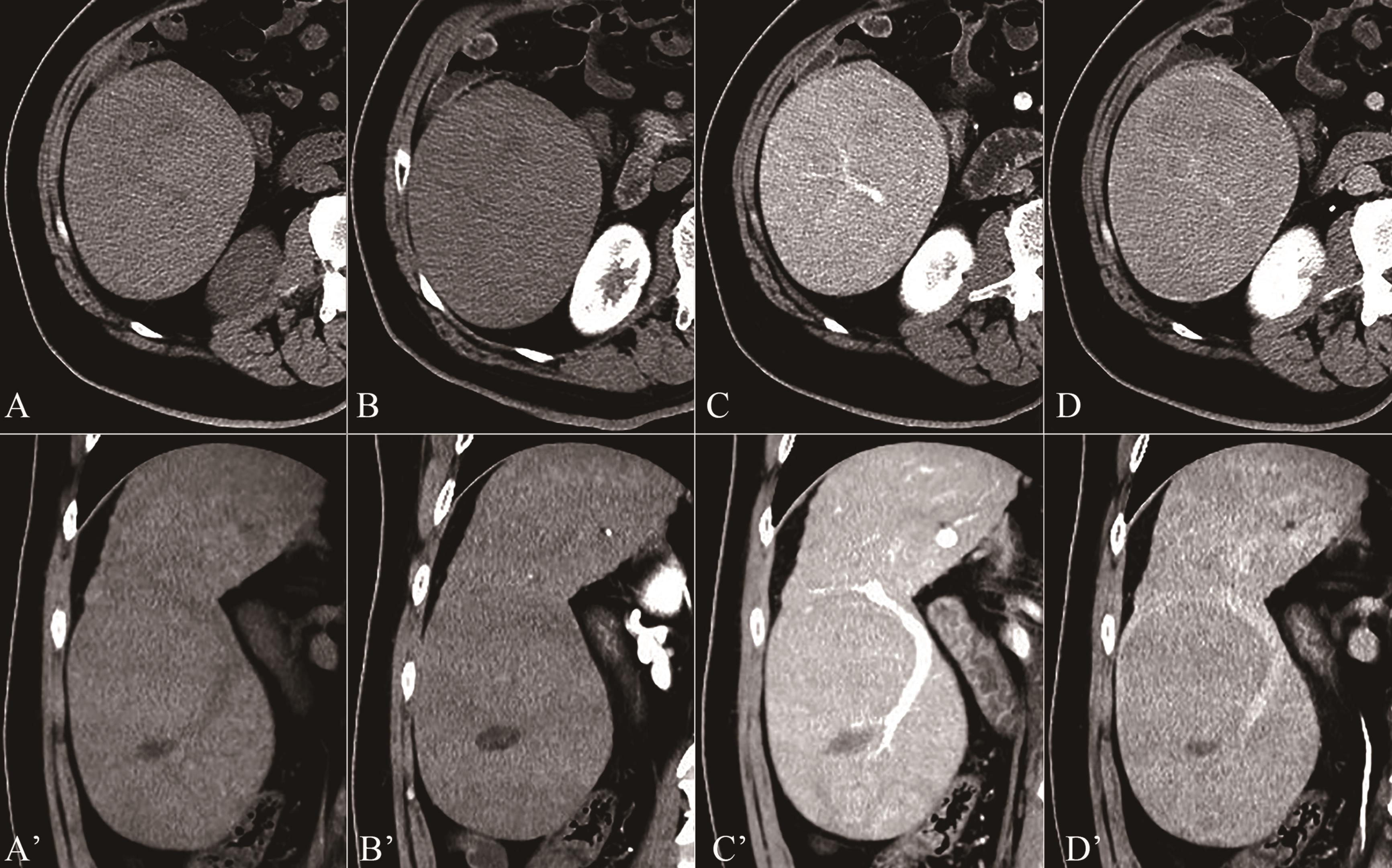 CT images of a giant hepatic mass.