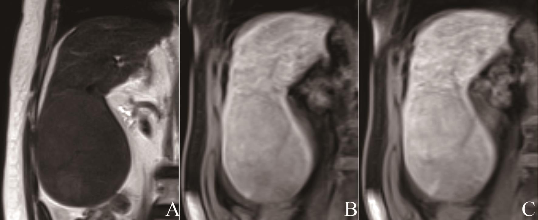 Follow-up contrast-enhanced MRI with gadoxetic acid.