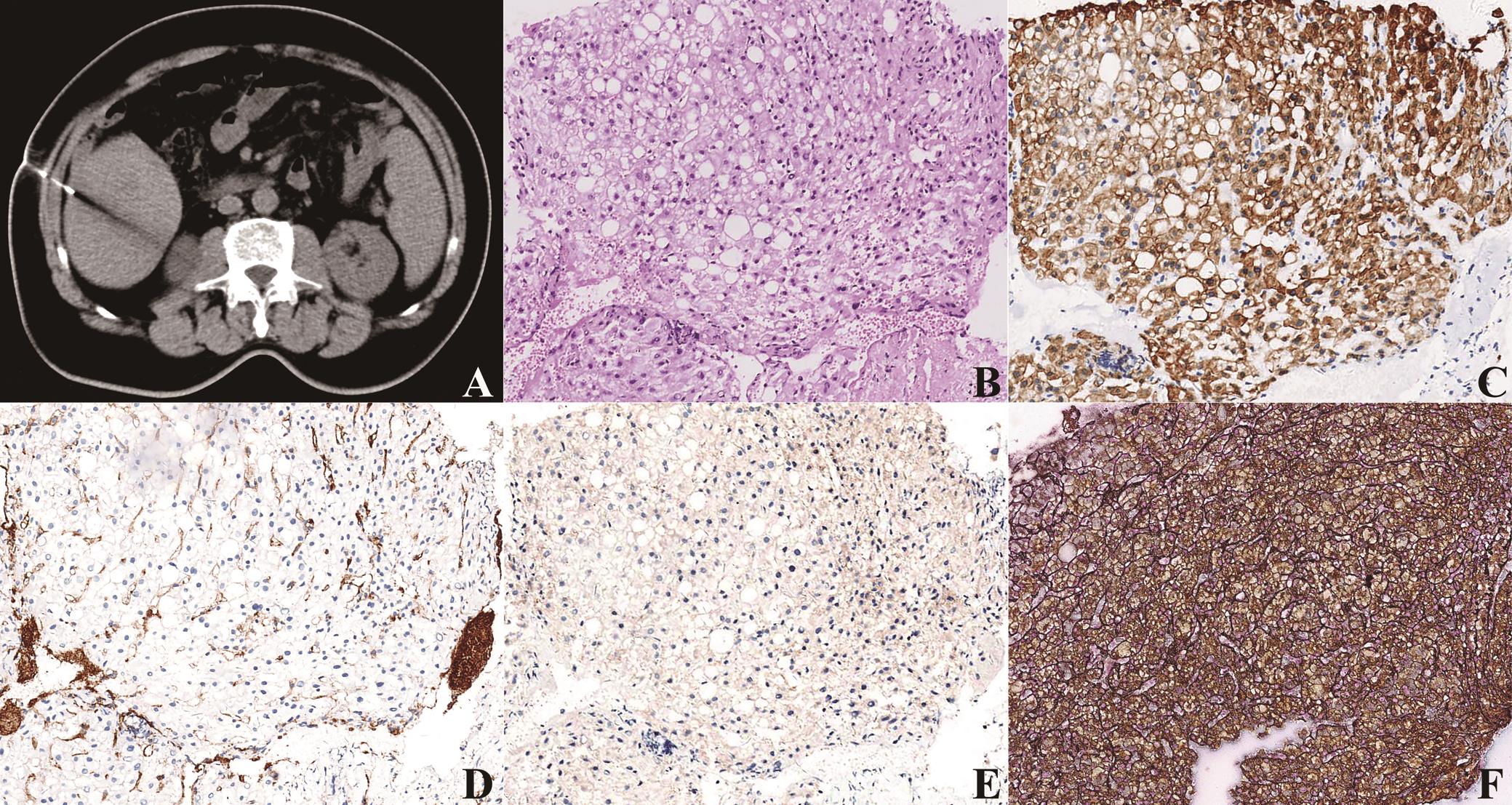 CT-guided percutaneous biopsy and pathological findings of a giant mass in segment VI of the liver