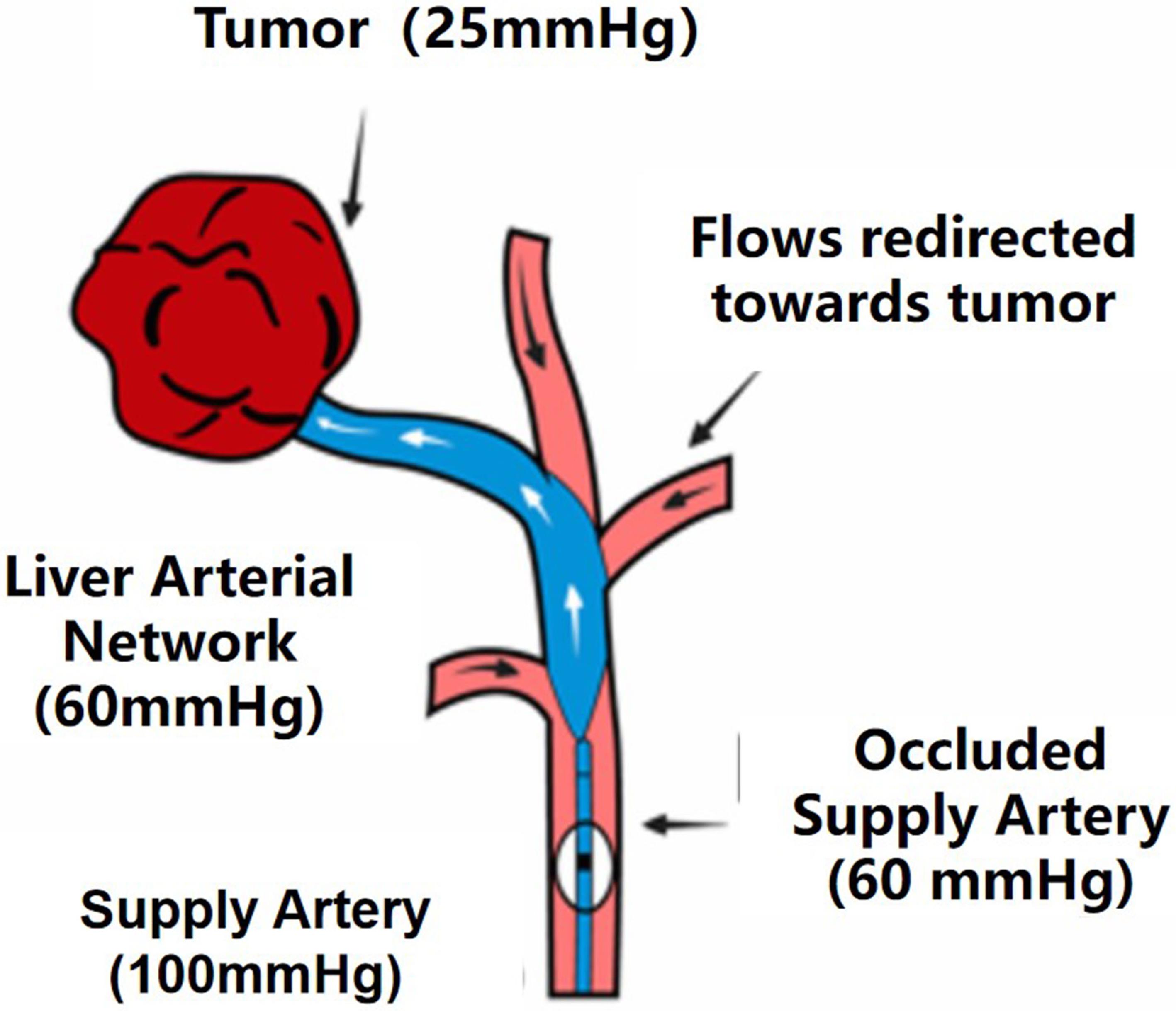 Low-pressure state with multiple arterial feeders.