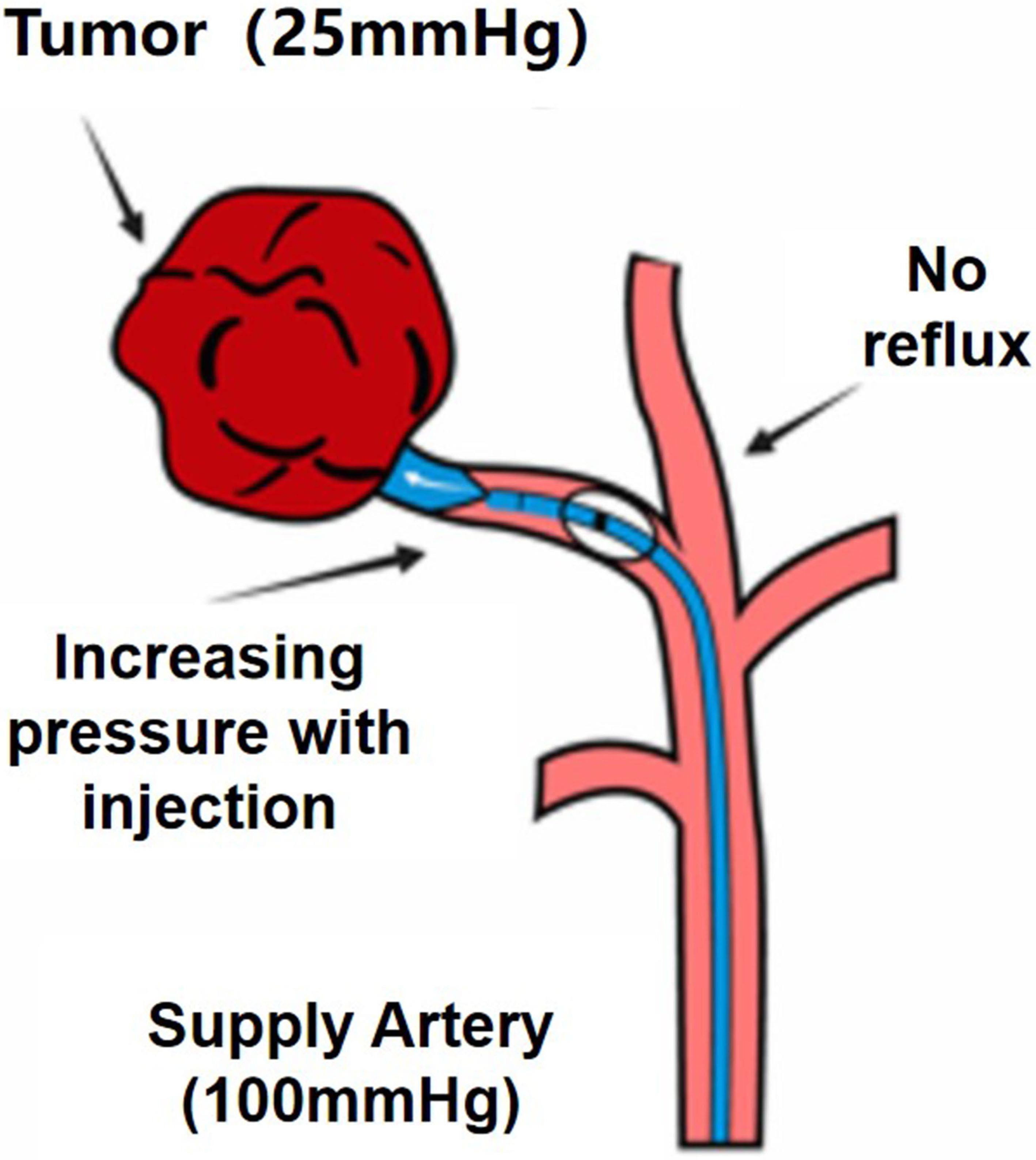 High-pressure state with exclusive tumor arterial supply.