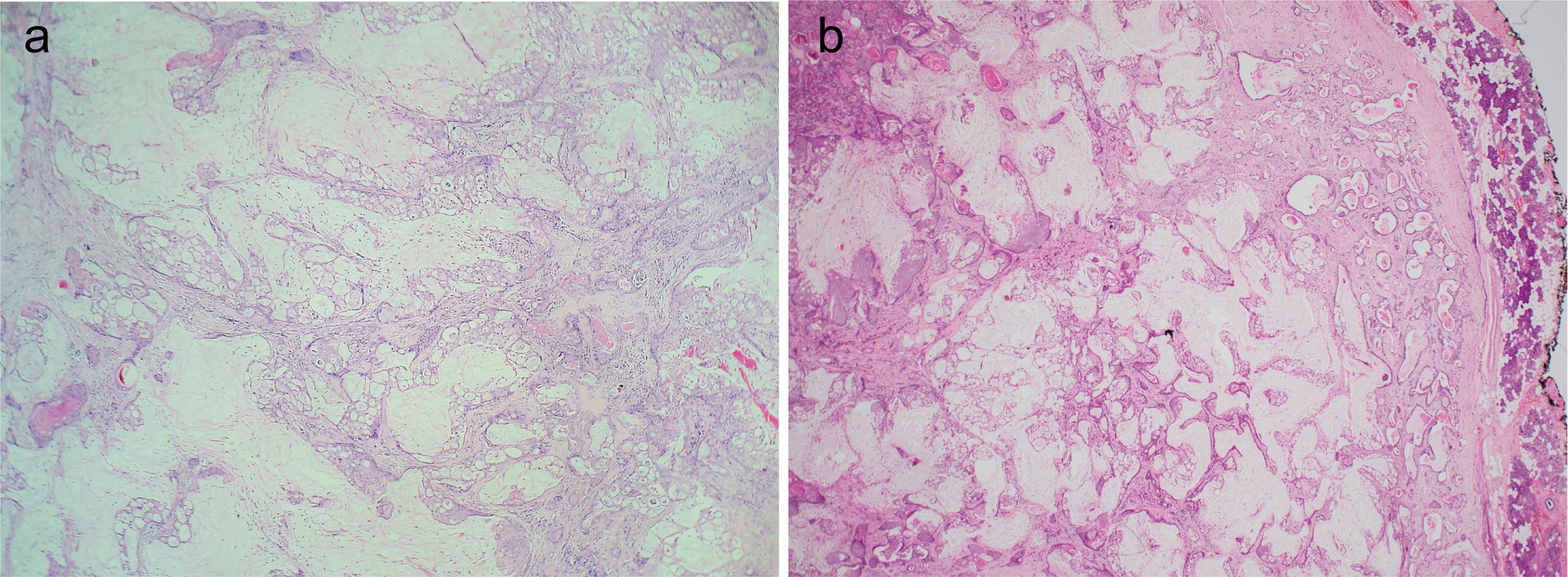 Histopathological examination of parotidectomy material.