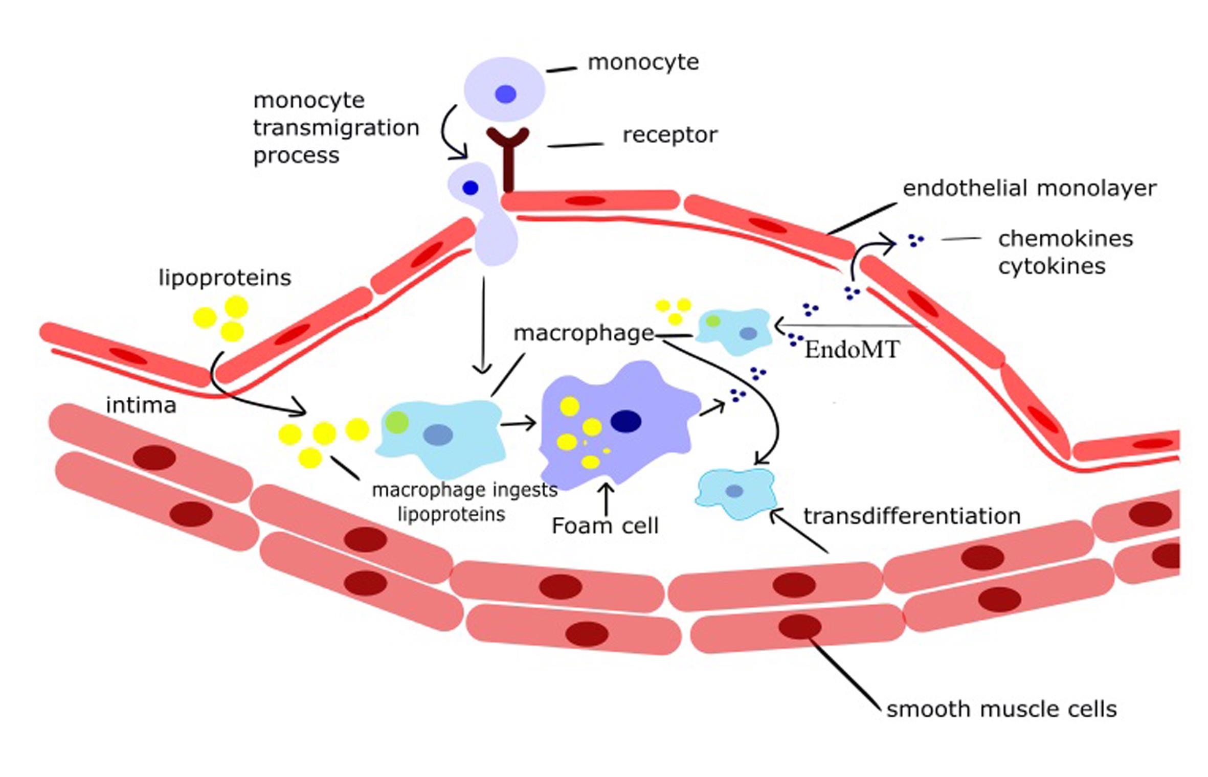 Accumulation of lipids by macrophages and the formation of foam cells.