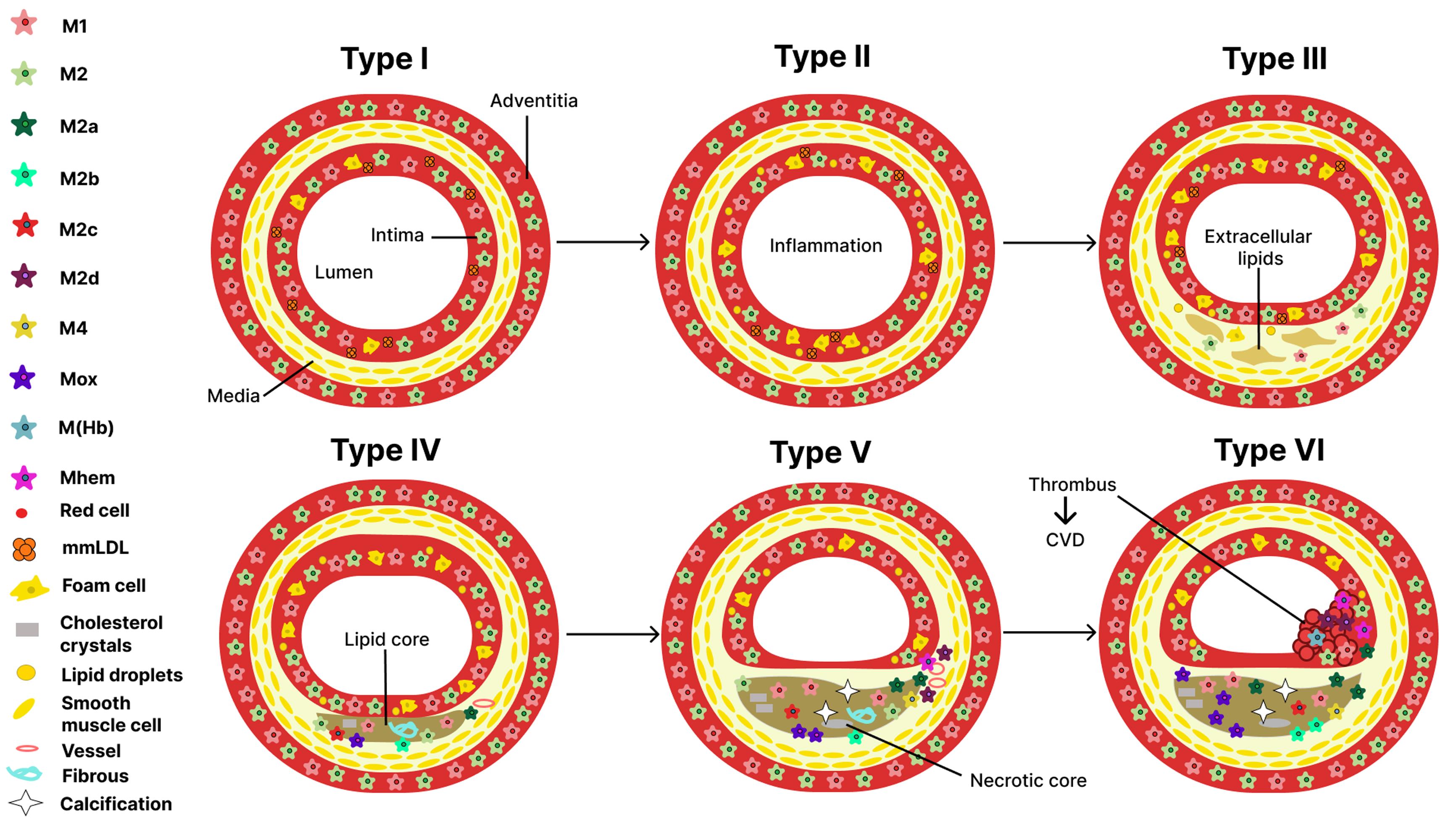Localization of macrophage subtypes during different stages of atherosclerotic lesion development.