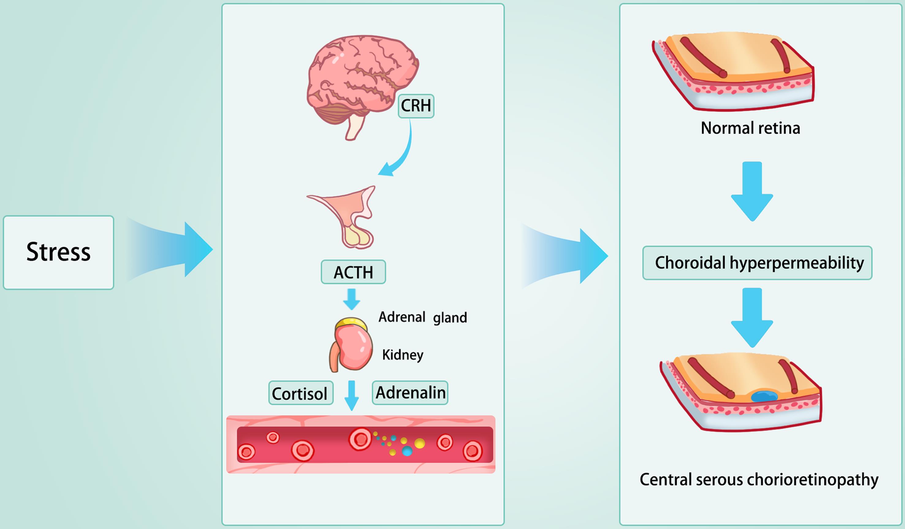 Hypothesized pathogenesis of central serous chorioretinopathy.