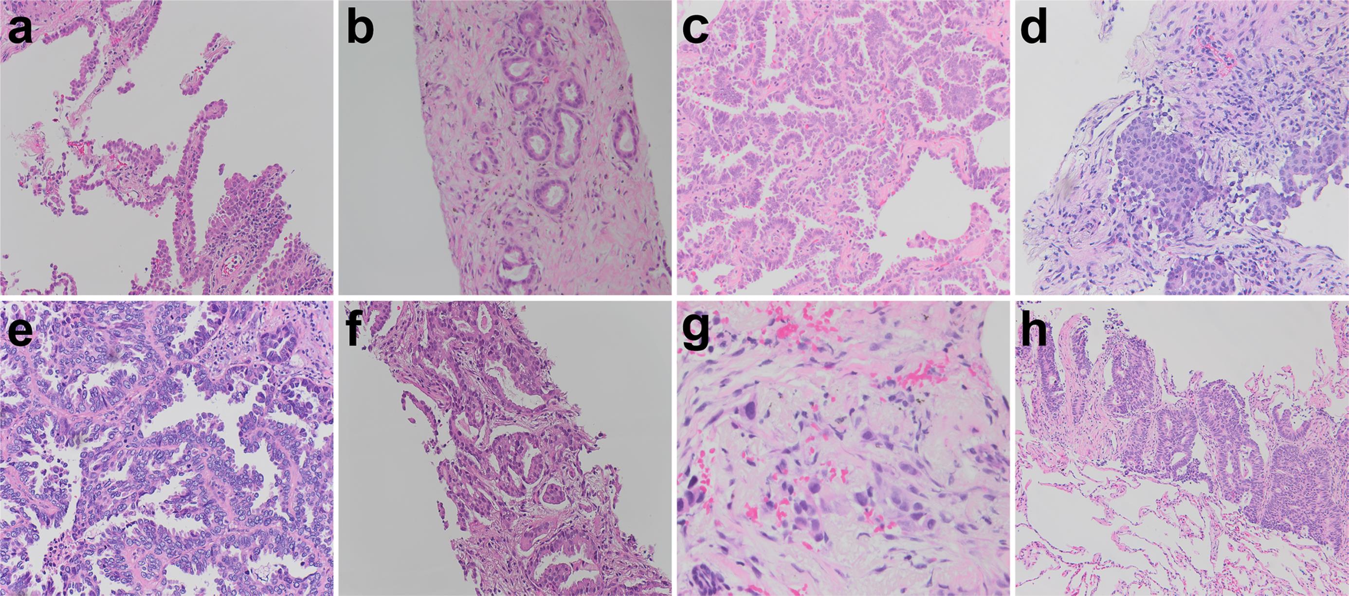 Primary lung adenocarcinoma growth patterns.