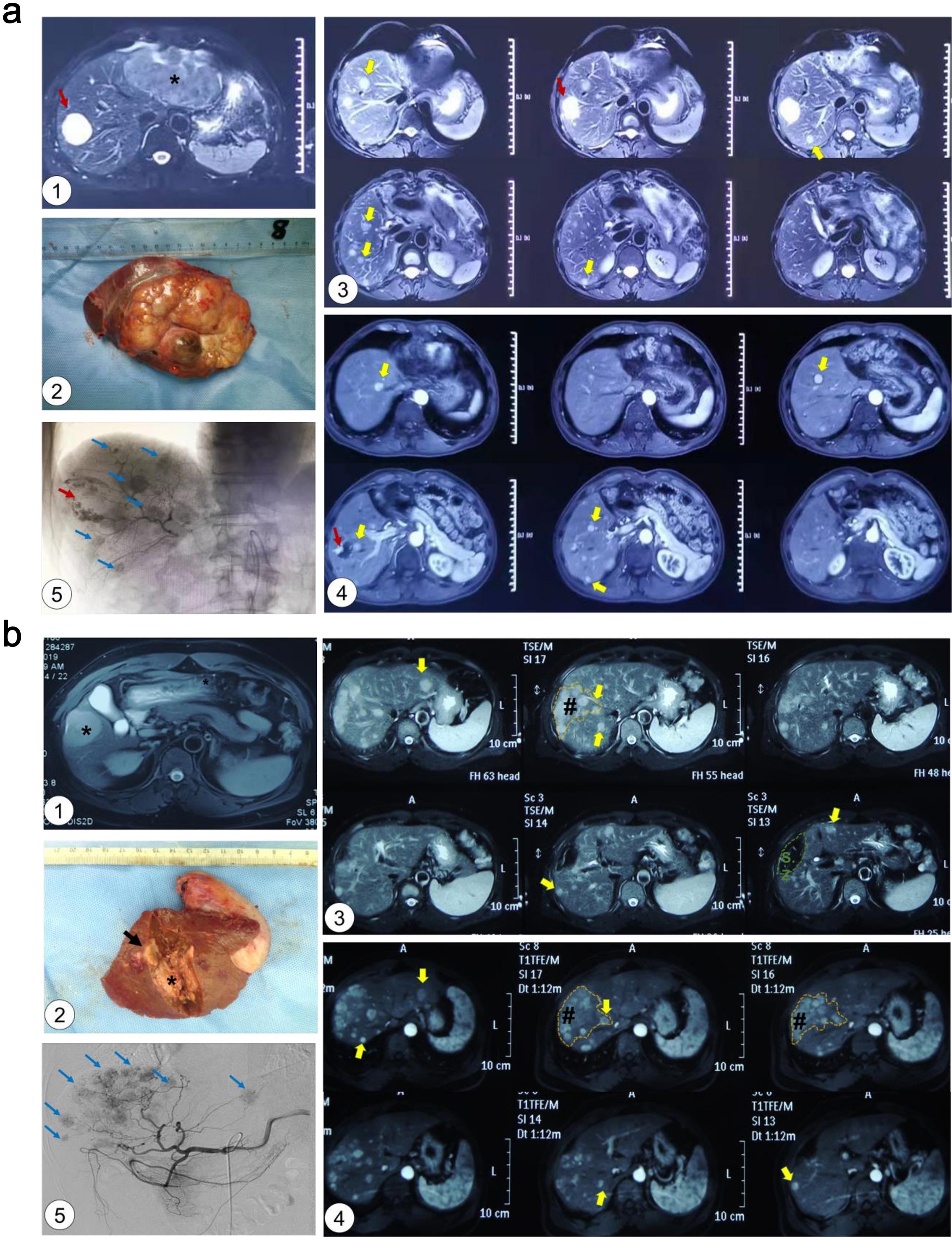 Representative cases of EER of HCC after liver radical resection.