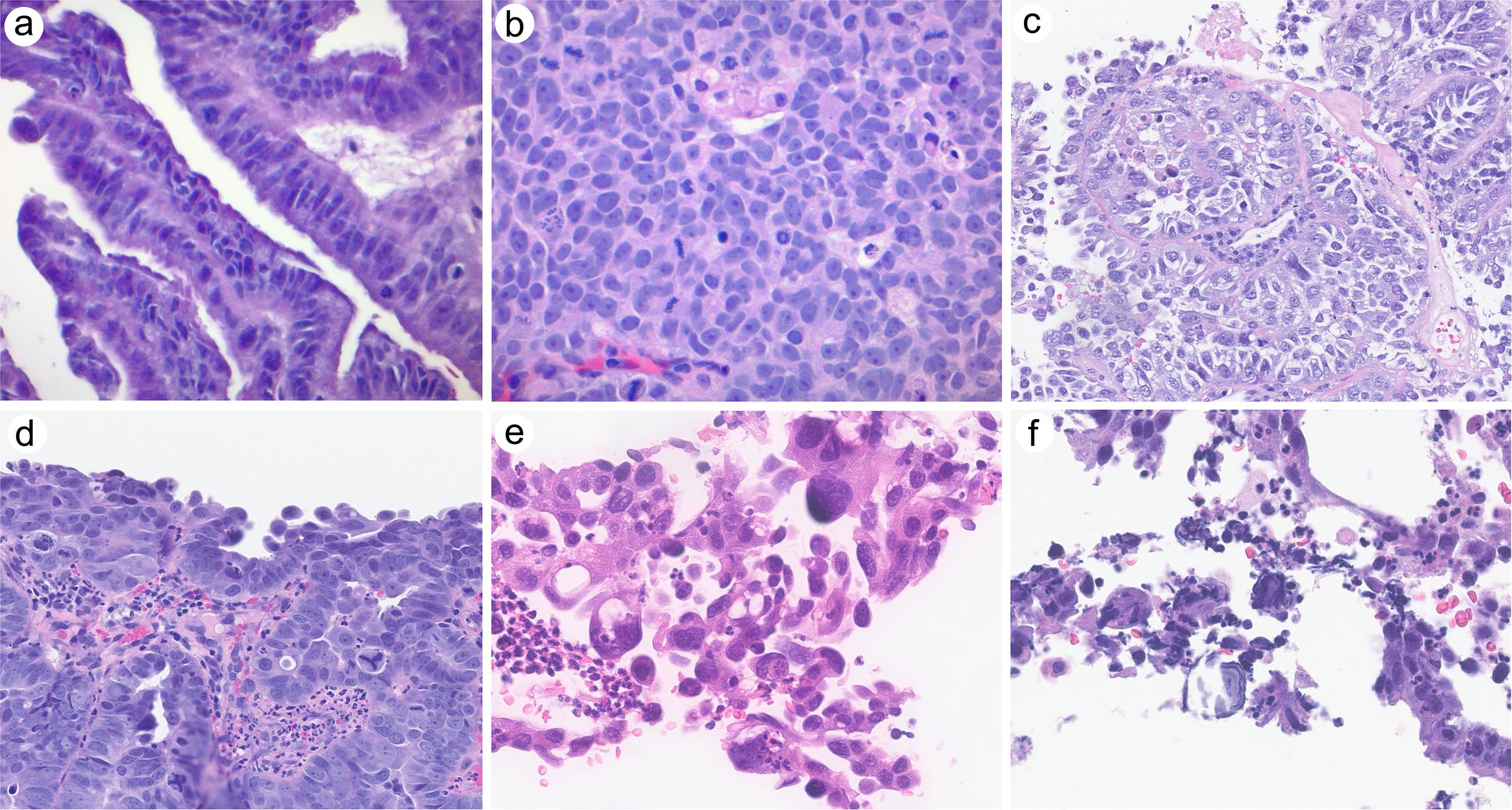 Variable morphologic features of high-grade serous carcinoma involving the cervix.