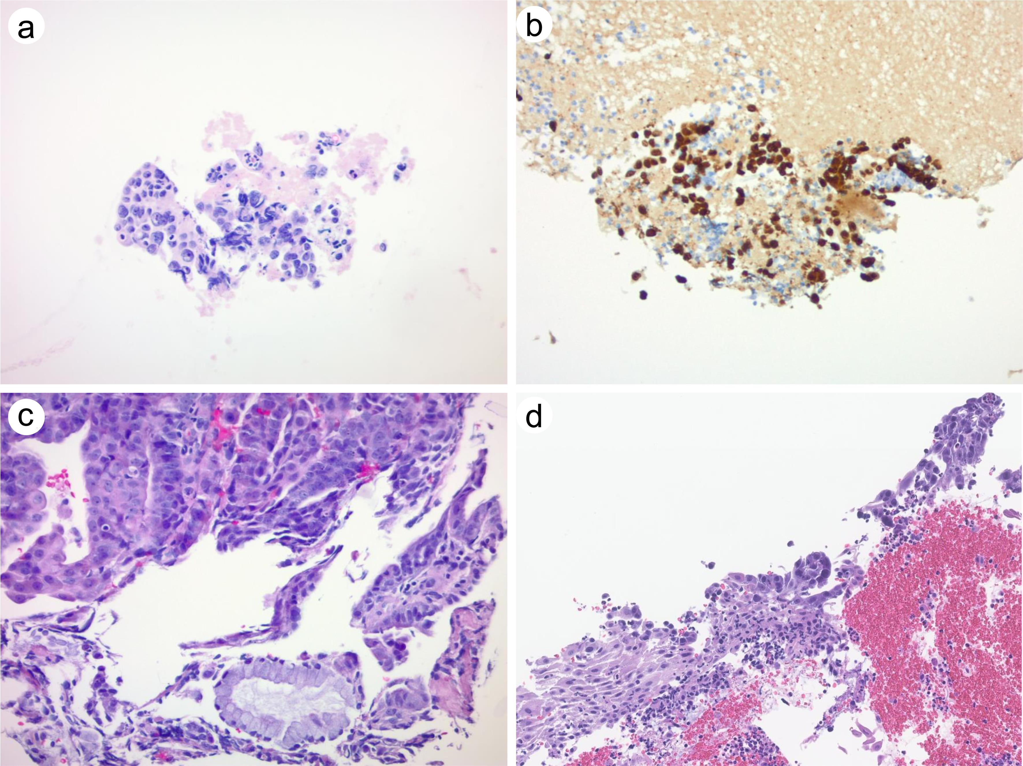Subtle histologic features of high-grade serous carcinoma involving the cervix.