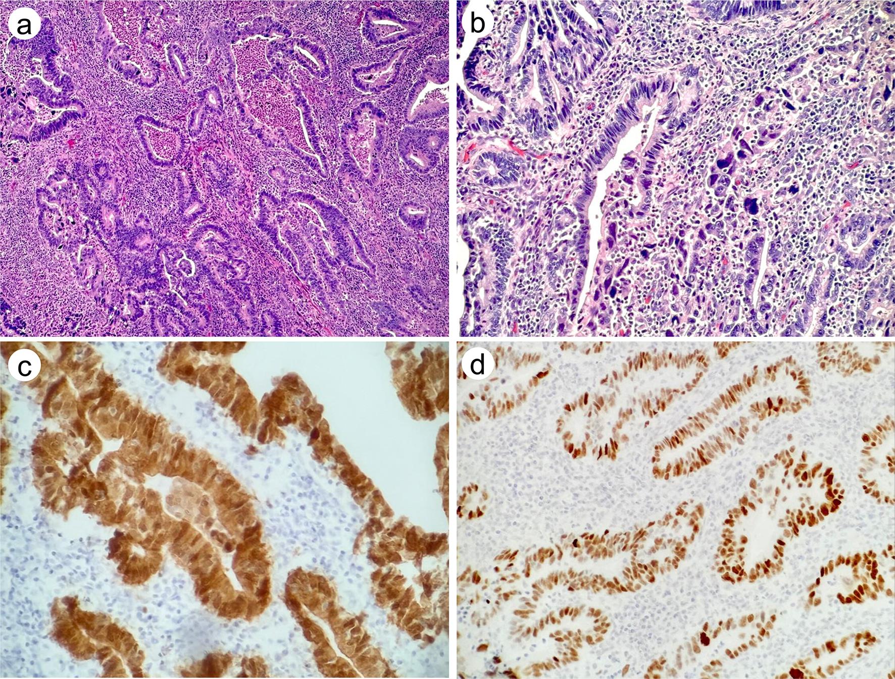 Histologic and immunohistochemical findings of a cervical adenocarcinoma with serous-like features.