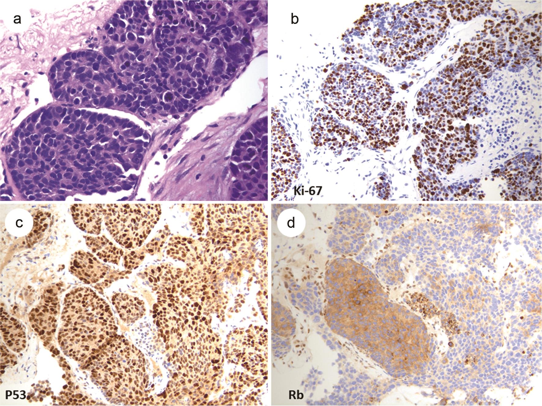 Poorly differentiated, metastatic neuroendocrine carcinoma (large cell neuroendocrine carcinoma) in a liver biopsy.