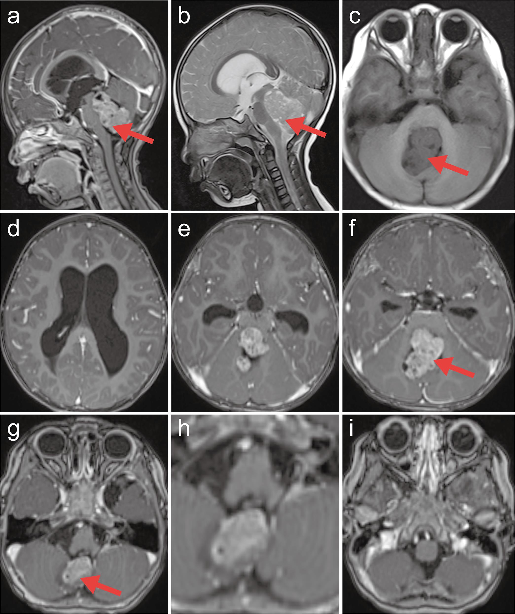 Preoperative imaging findings of the atypical teratoid/rhabdoid tumor.
