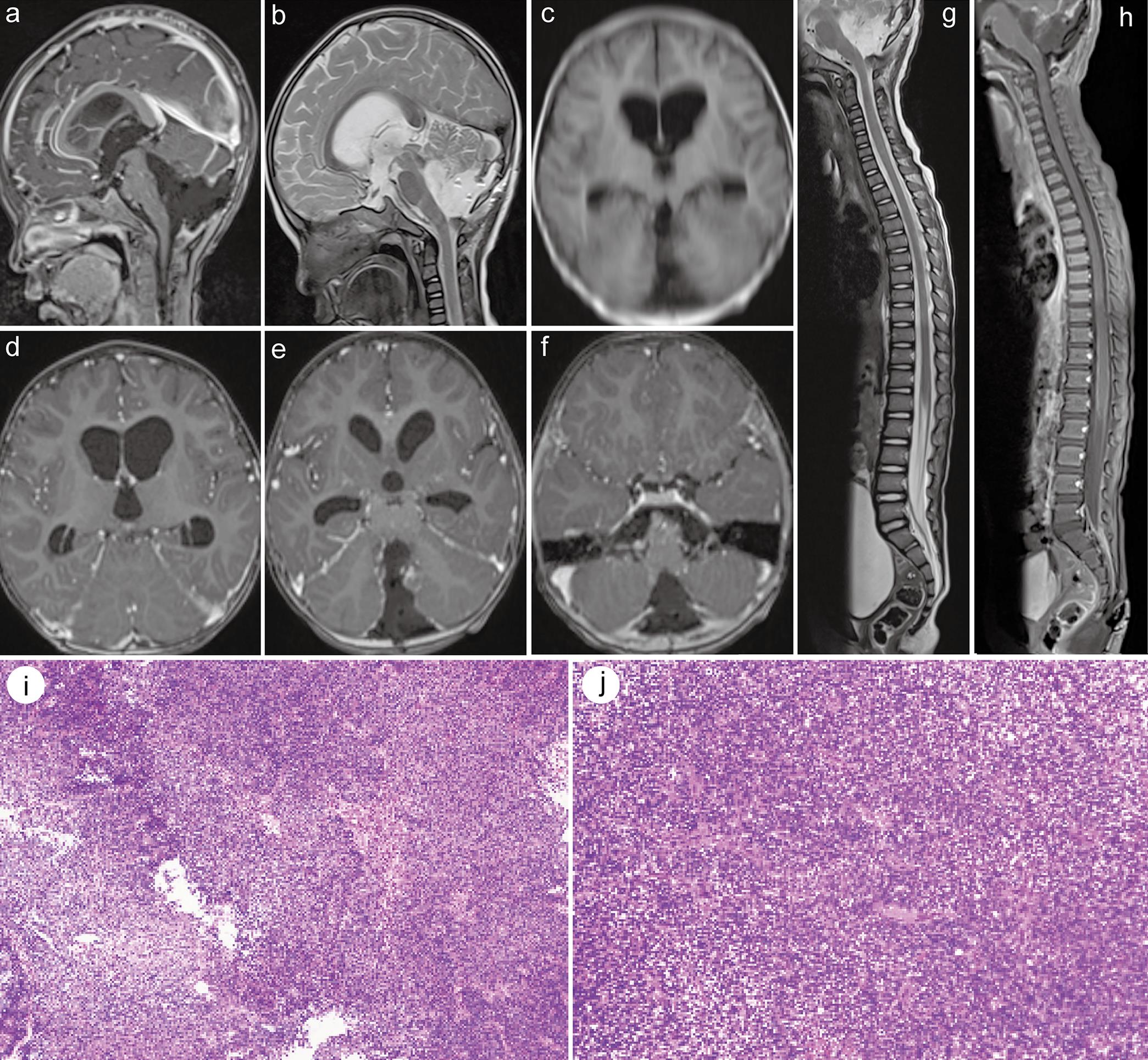 Postoperative pathological and imaging manifestations of atypical teratoid/rhabdoid tumors.