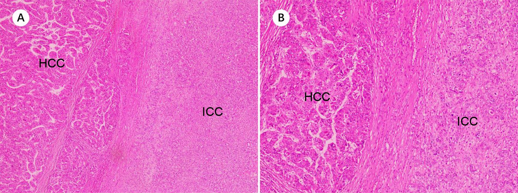 Combined hepatocellular cholangiocarcinoma without transition zone.