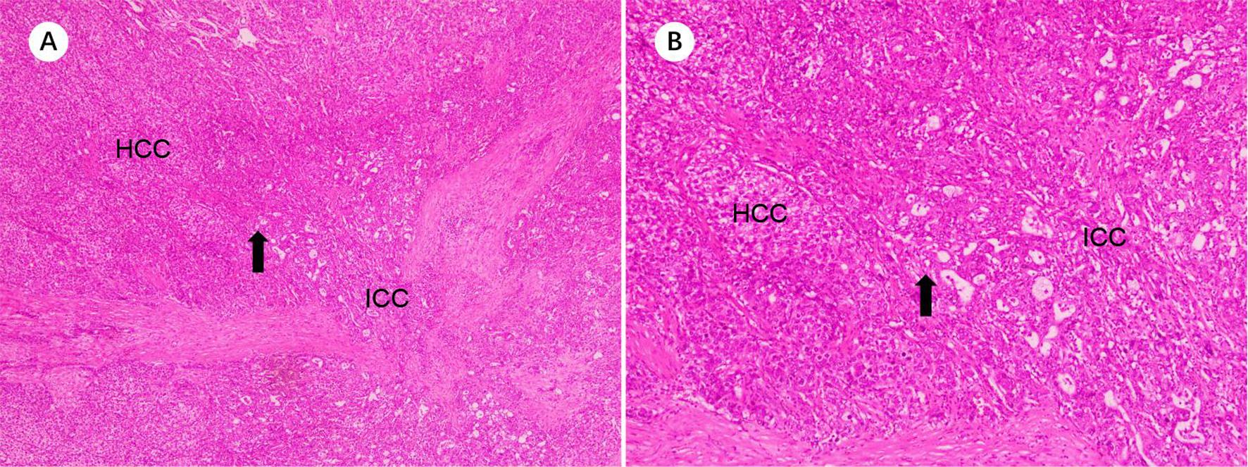 Combined hepatocellular-cholangiocarcinoma with a transition zone.