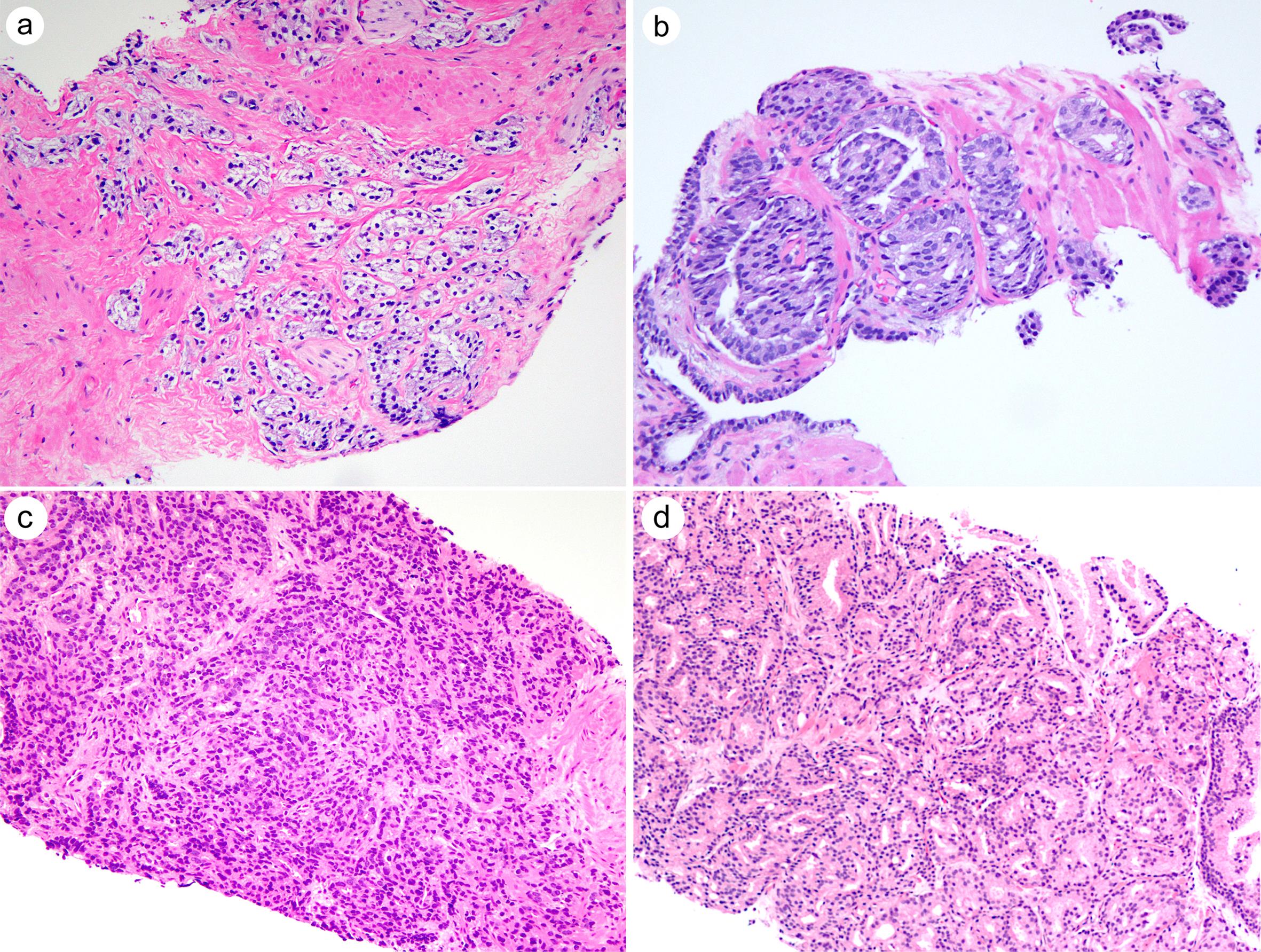 Representative images of Gleason pattern 4 sub-patterns.