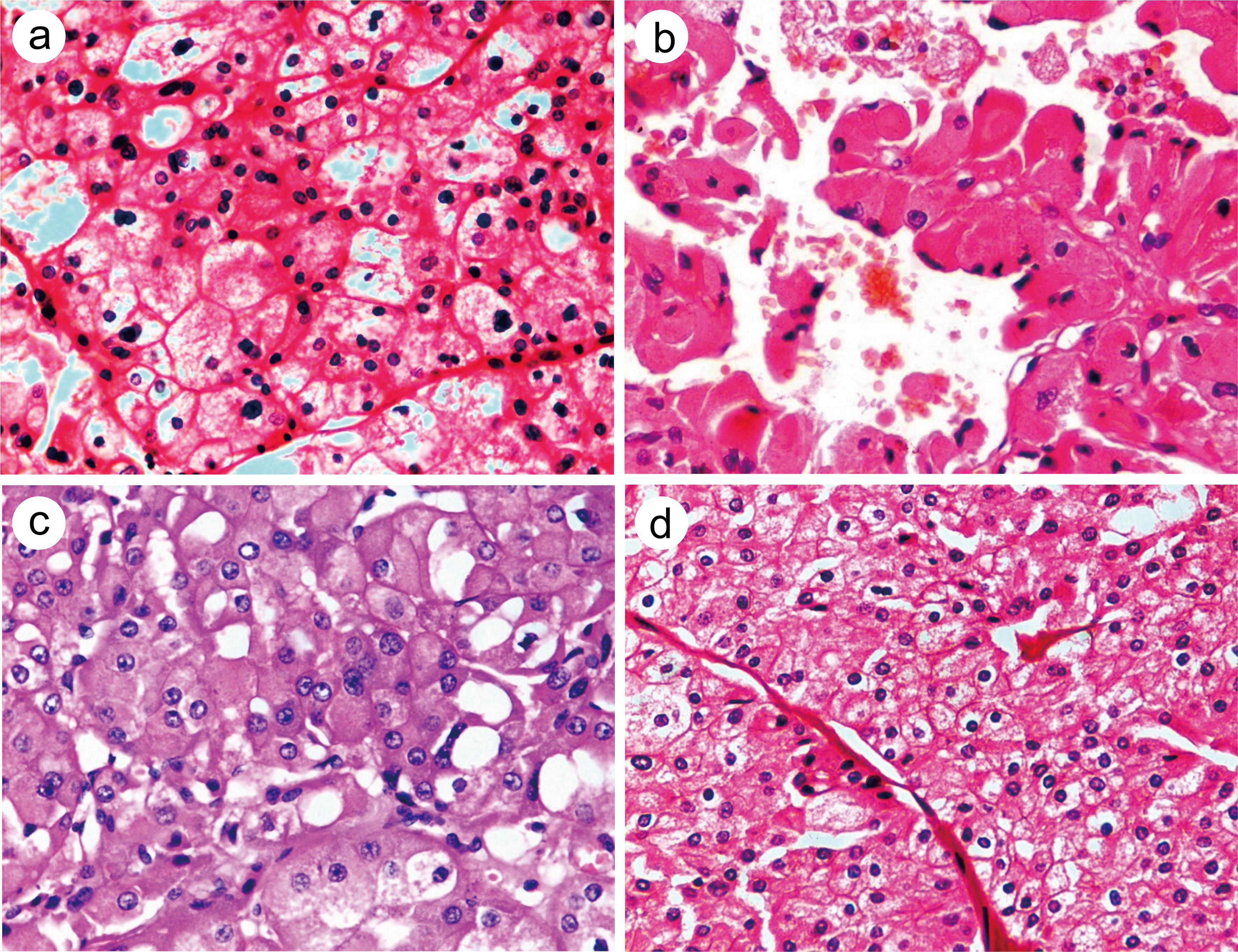 The main morphological types of some emerging/novel renal cell tumors.