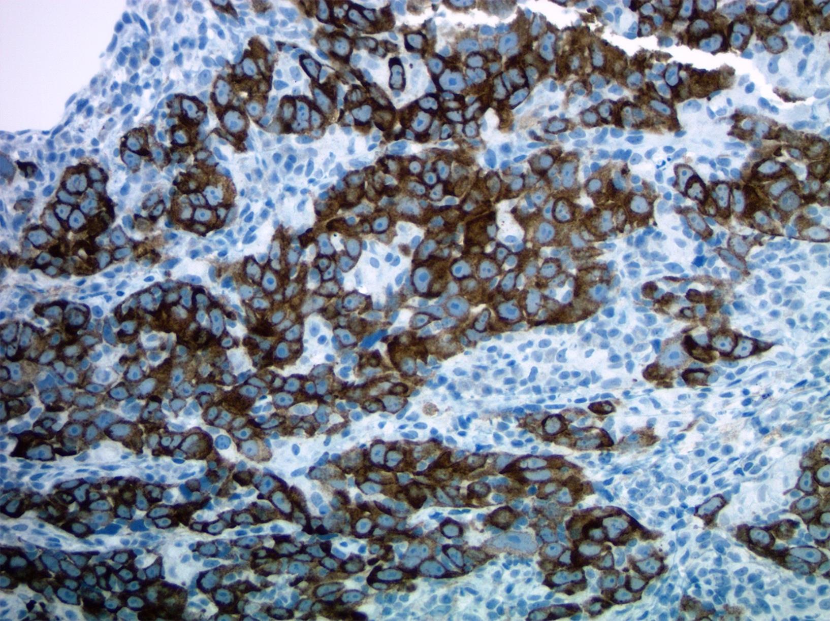 Tumor stained with the anti-cytokeratin clone OSCAR.