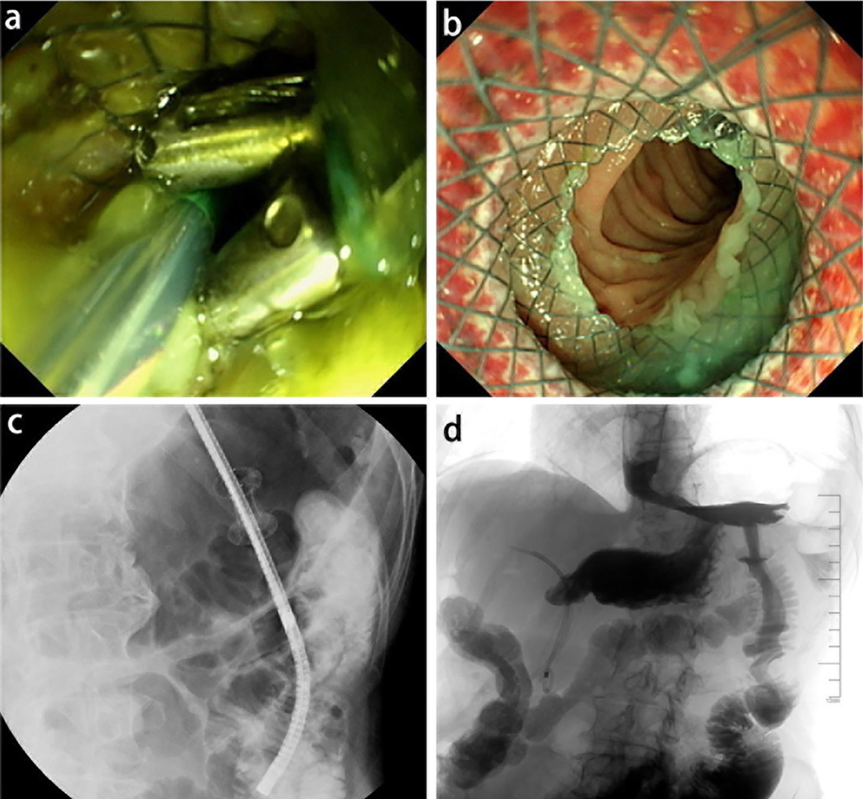 Endoscopic ultrasound-guided gastroenterostomy after disuse of a metal stent for malignant gastric outlet obstruction.