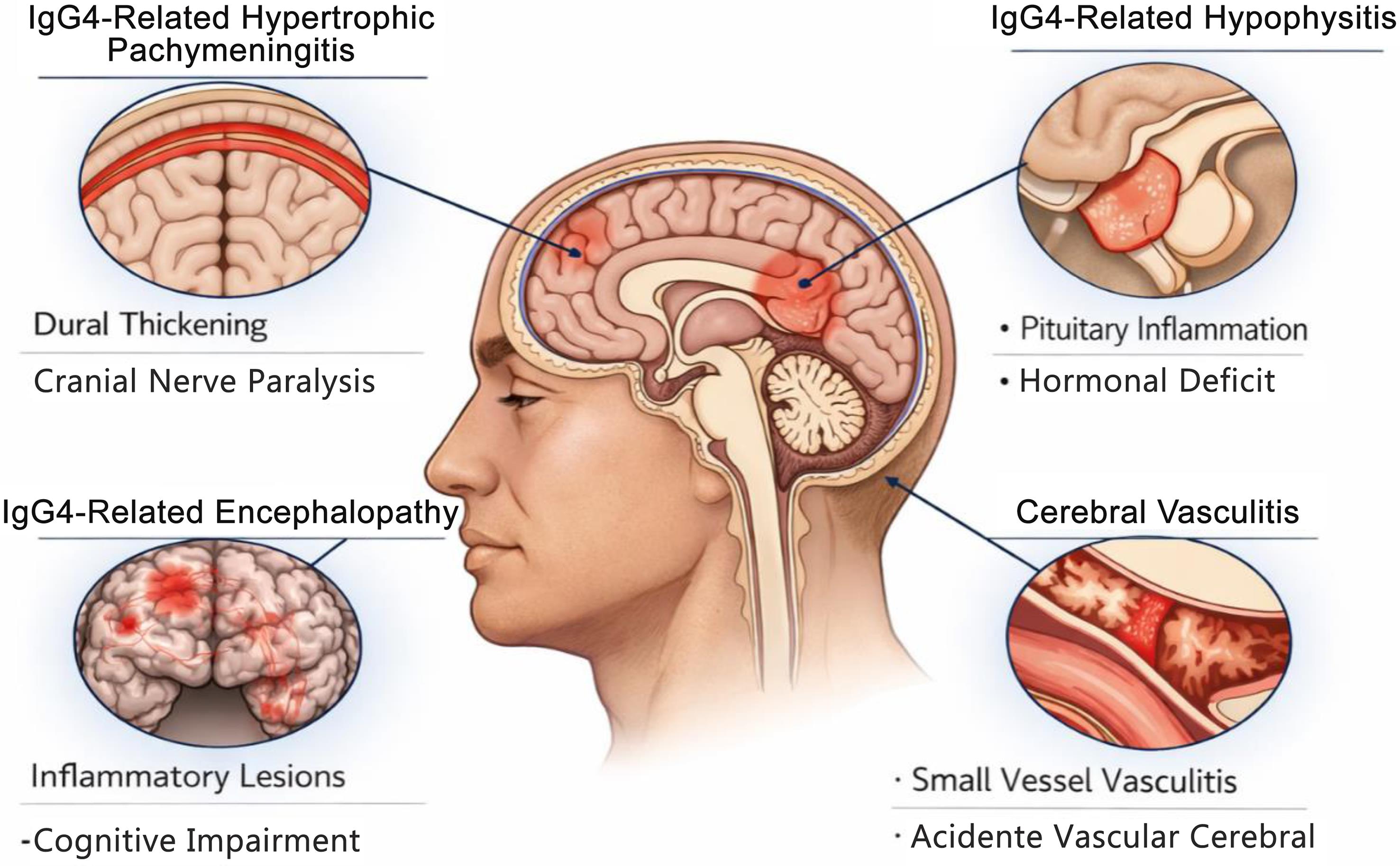 Major manifestations of IgG4-RD in the central nervous system.