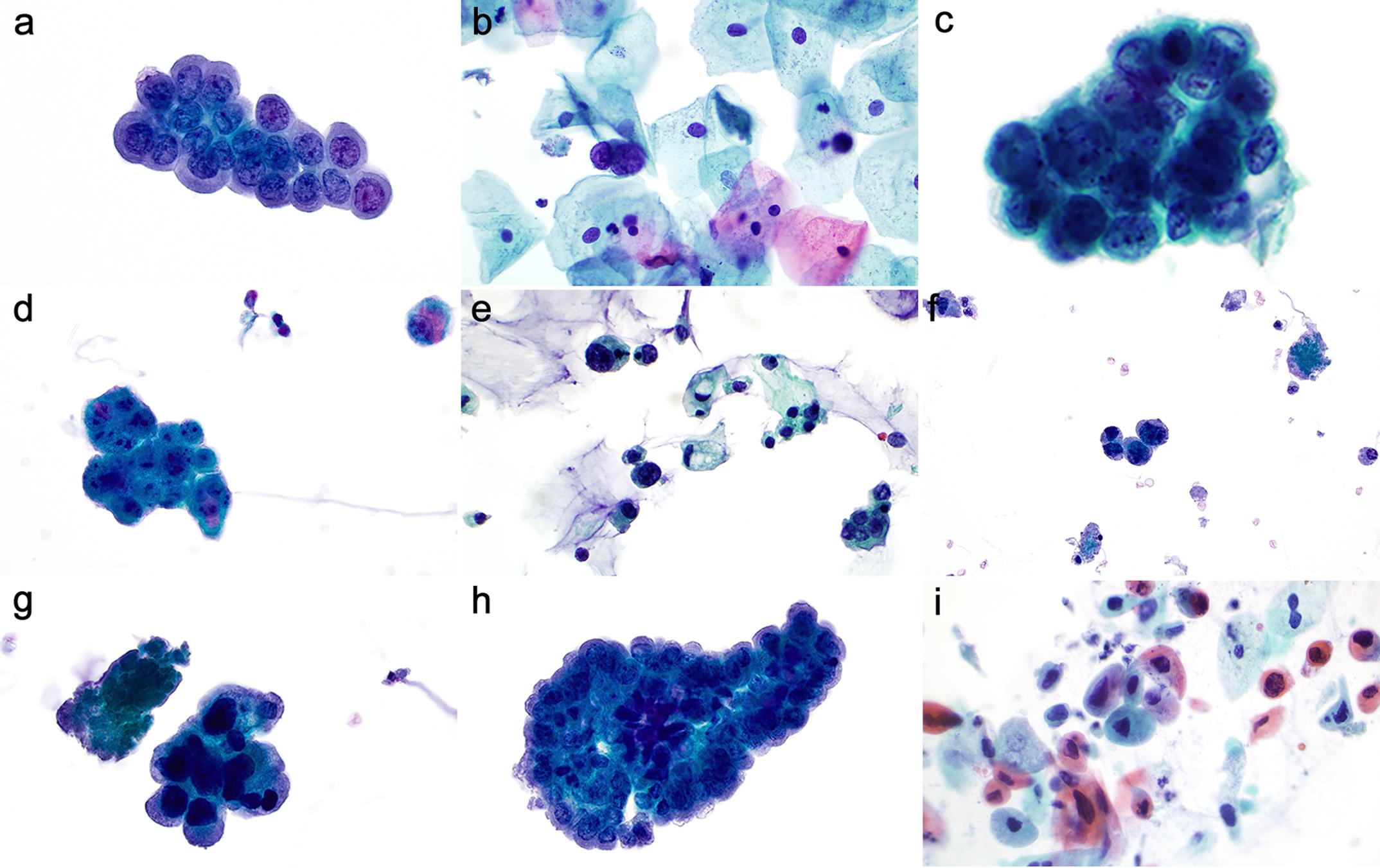 Atypical urothelial cells (AUC), suspicious for high grade urothelial carcinoma (SHGUC), and high-grade urothelial carcinoma (HGUC).