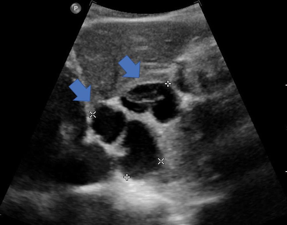 BMCA with typical ultrasound findings of an anechoic lesion with thickened and irregular walls, and internal septations.