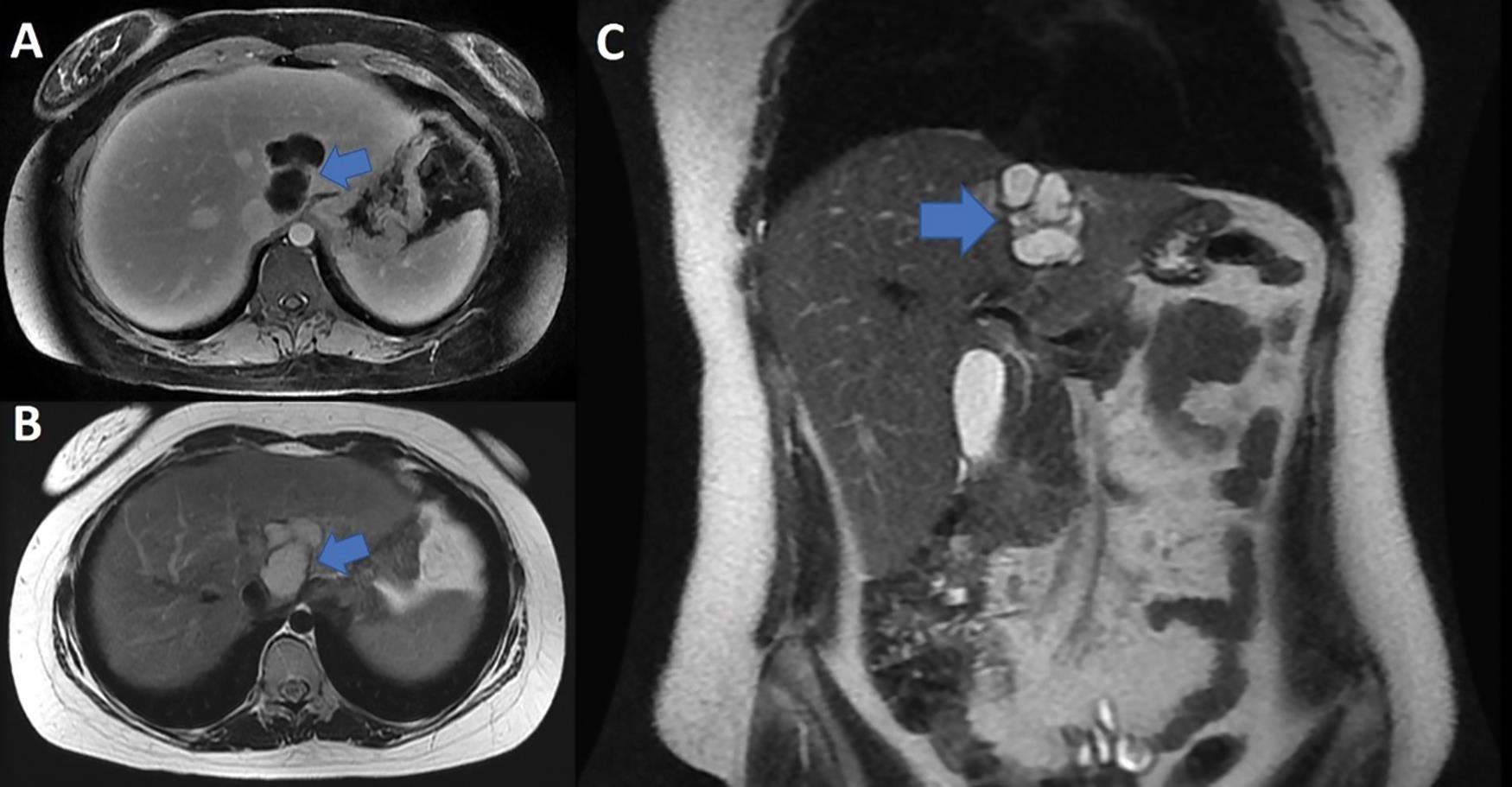 BMCA findings on magnetic resonance imaging showing a septated and multilobulated lesion on T1-weighted imaging (A) and hyperintense signaling on T2-weighted imaging (B–C).