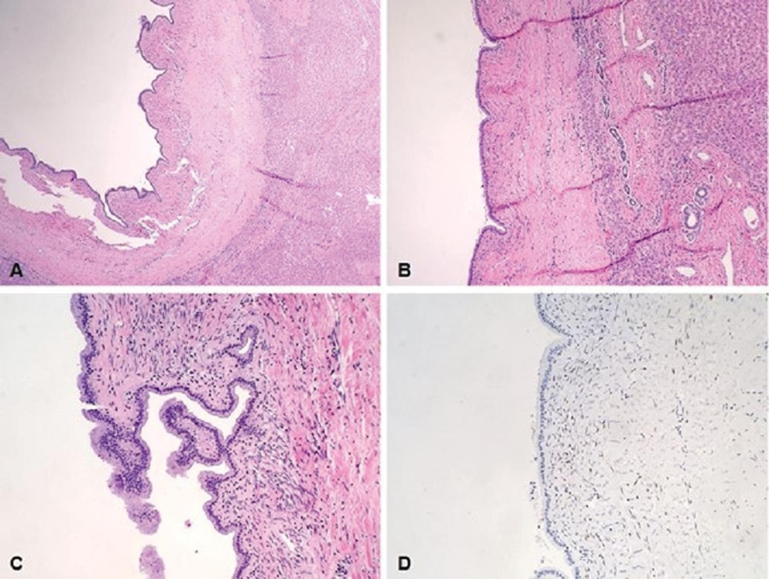 Histologic features of biliary cystadenoma.