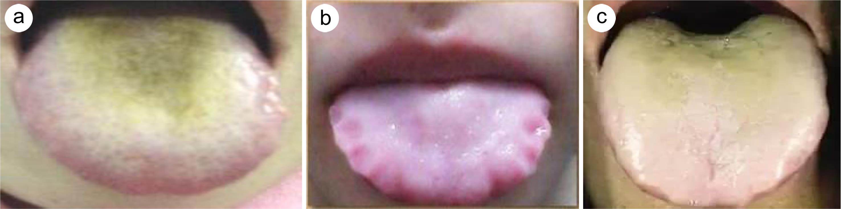 Tongue images of the three types of <italic>Helicobacter pylori</italic>-associated “disease-syndrome”.