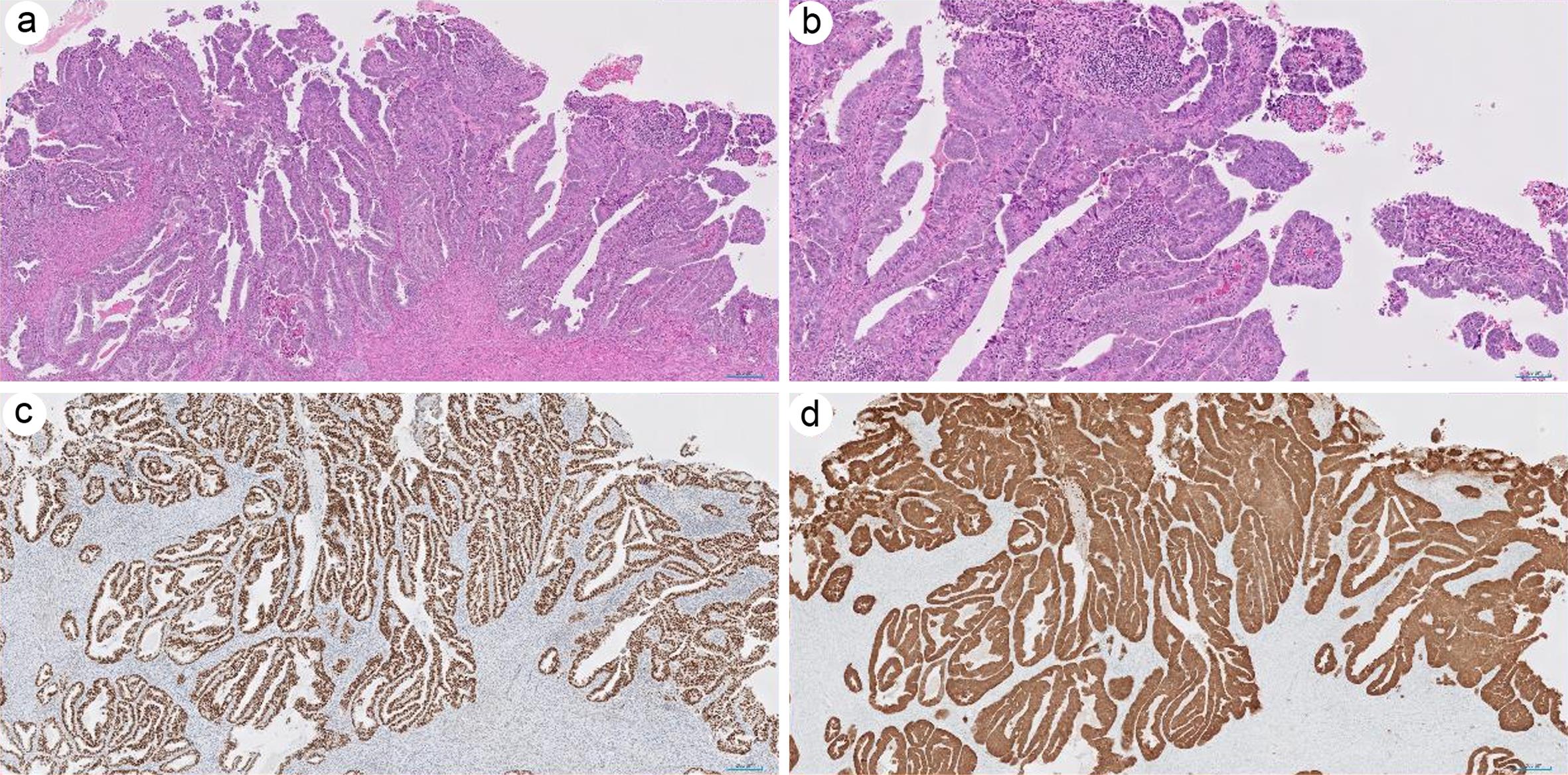 Endometrial serous carcinoma.